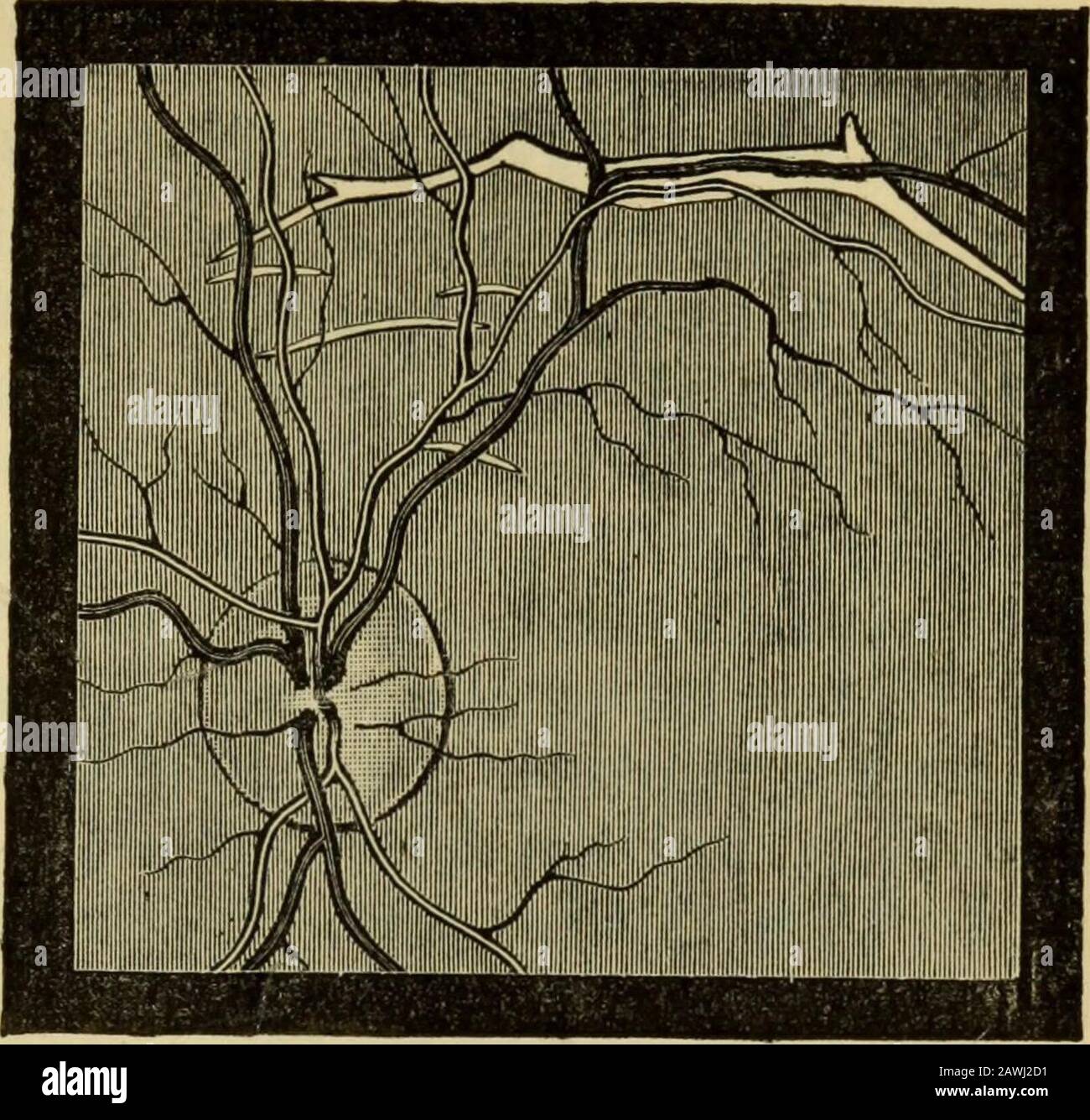 Le guide de l'étudiant sur les maladies de l'œil . Fig. 20 68.— Section du tubercule biliaire. Couches intérieures de choroïdcomparativement non affectées. L'ombrage plus léger, l'artère capitudingan dans la partie la plus profonde du tubercule, representsla partie la plus ancienne, qui est la casoalimentation; une artère est vue coupée dans cette partie du tubercule. Incomplète; nous trouvons ensuite, en plus de l'atrophie, des taches grises ou blanches, ou des lignes, qui, dans le modèle et l'apparence, nous rappellent des cicatrices de keloïdes dans la peau, orof des taches et des lignes d'épaississement ancien sur les serousmembranes. Des changements très caractéristiques sont observés après la rupiredu choroïde Banque D'Images
