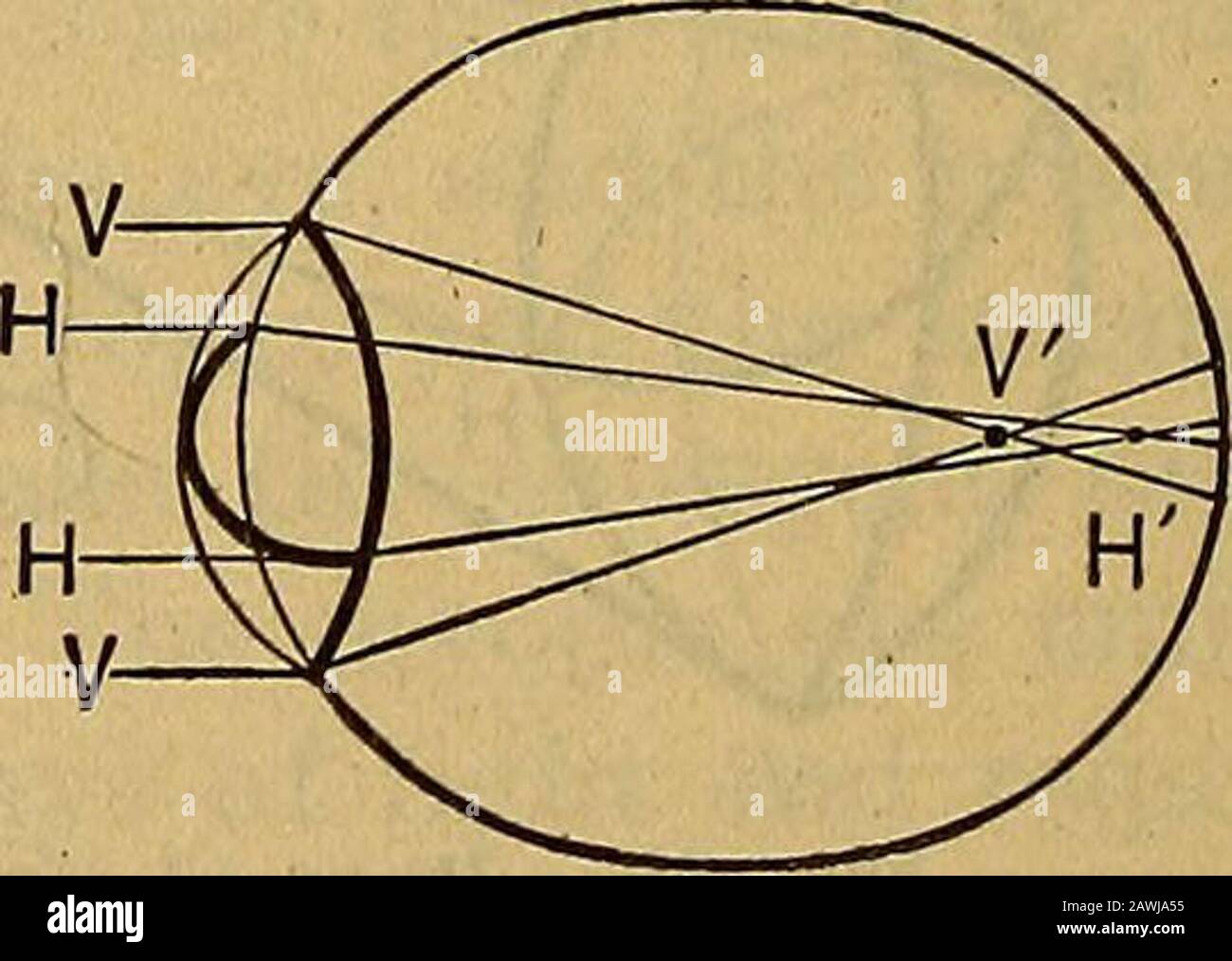 Manuel d'ophtalmologie . Fig. 32. Fig. 33. Figure 32. Cela montre que les deux méridiens sont hyperopiques, le hori-zontal plus que la verticale, c'est-à-dire l'astig-matisme hypertopique composé^ les lentilles de correction étant une sphère plus et un cylindre plus. C'est une condition d'ametropia axial combinée à un simple hyperopicastigmatisme. Figure 33. Ceci illustre l'astigmatisme myopique composé, le réverset de celui illustré à la figure 32. Les deux méridiens se concentrent dans le vitre-ous, c'est-à-dire, il y a une ametropia axiale combinée avec la curvatureametropia. La lentille de correction est une sphère négative avec un mini-cylindre. REFRAC Banque D'Images