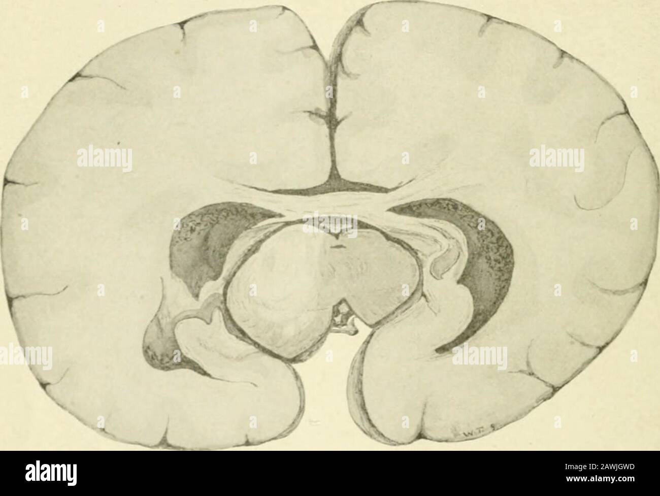 Le Journal des maladies nerveuses et mentales . e glande pinéale ou hypophyse, celles du priapisme et de la croissance du squelette. Dans aucun des 18 cas de tumeur du crus heretoforepublié, de tels symptômes ont été mentionnés. Comme aucun des théseglands n'était anormal, comme montré à la nécropsie, ont été produits 5o8 WALTER TIM ME par la pression dans le troisième ventricule transmis à l'ananas ou à la tige hypophysaire, Ou étaient-ils issus de la directpression de la crus cerebri gauche (qui empiète centralement sur la ligne de l'énigme) sur l'hypophyse, et supérieurs contre l'pinéal?Comme le ven Banque D'Images