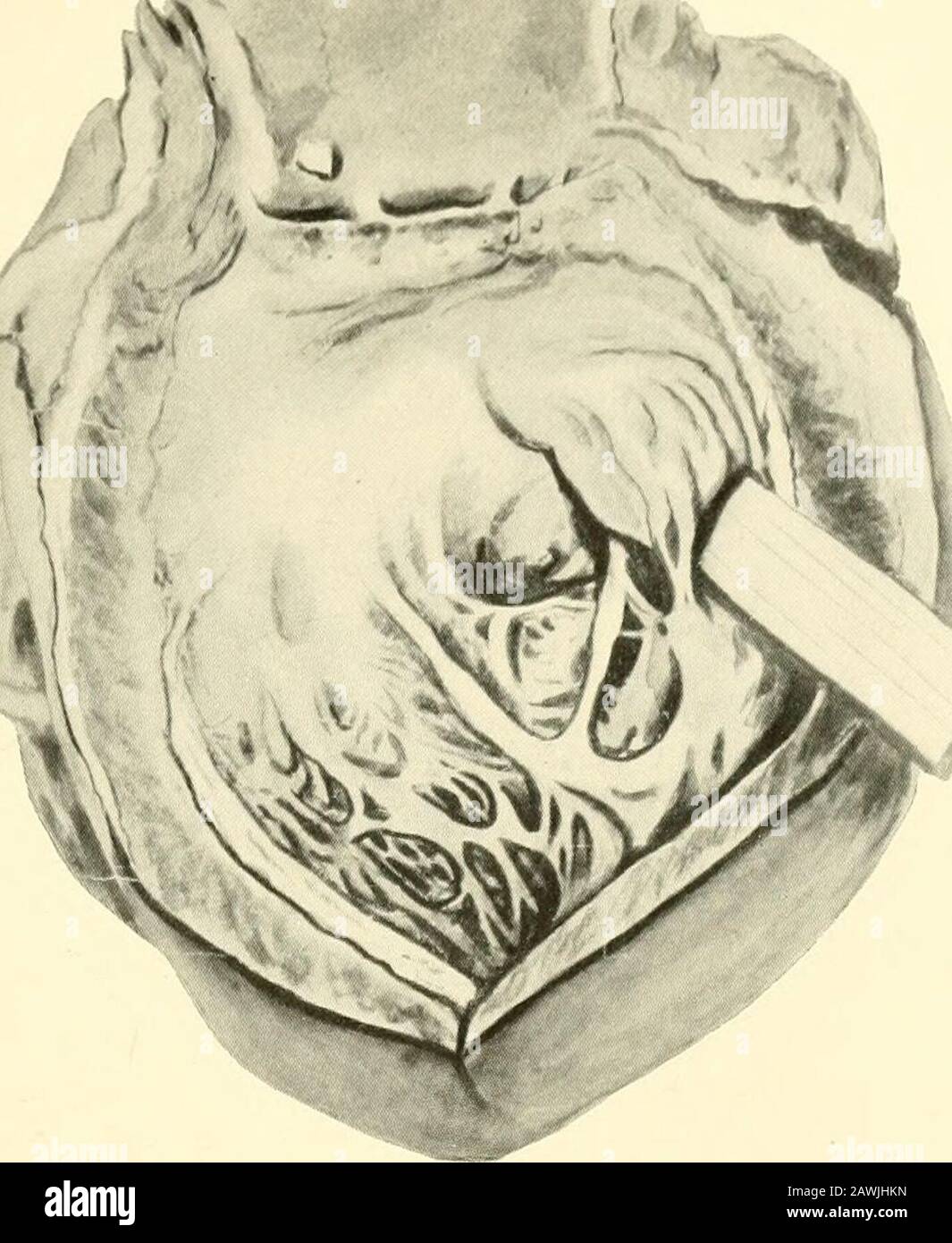 Gériatrie : les maladies de la vieillesse et de leur traitement, y compris la vieillesse physiologique, les soins à domicile et en établissement, et les relations médico-légales . la santé de sans, ou des poumons, pleural ou abdominale cavité. Ils sont donc susceptibles de se produire à la suite d'opérations chirurgicales, de empyema, de tuberculose, d'abcès ou de gangrène du poumon, d'un effort inspiratoire soudain provoquant une rup-ture d'alveoli dans la cavité et d'abcès de la cavité abdom-inale s'ouvrant à travers le diaphragme dans la cavité pleurallaire, etc. Pneumothorax et hydropneumothorax sont ex-tremely rares, et quand ils se produisent, ils bientôt beco Banque D'Images