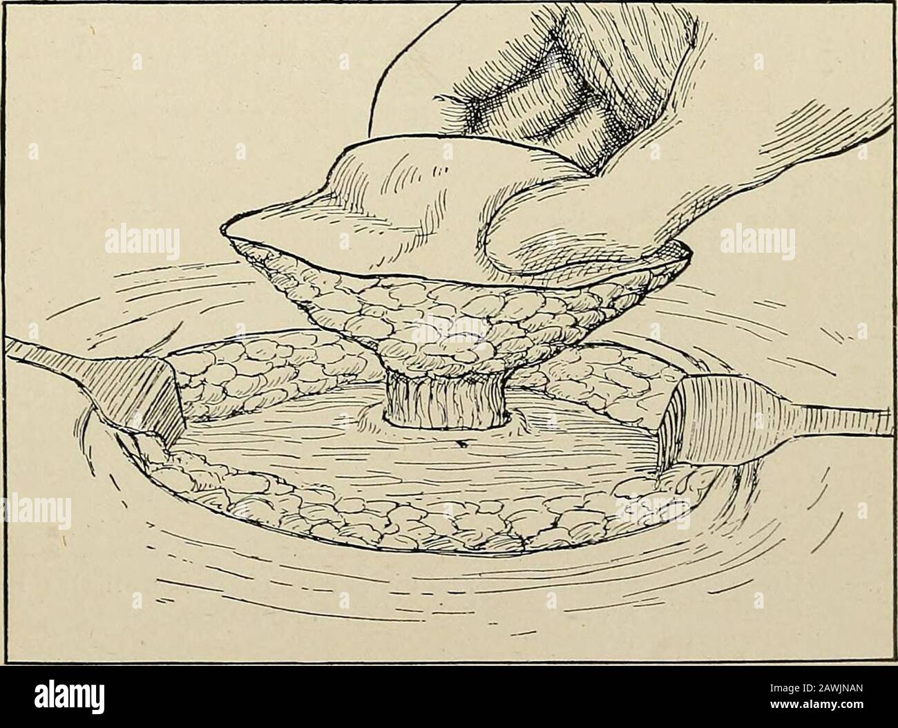 La pratique de la chirurgie . Fig. 123.—hernie ombilicale Adulte ...