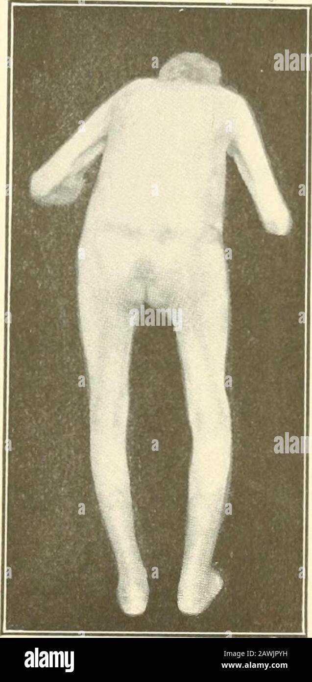 Gériatrie : les maladies de la vieillesse et leur traitement, y compris la vieillesse physiologique, les soins à domicile et en établissement, et les relations médico-légales . Pseudo-palets maladie. Xouvelle Iconographique de la Salpetriere, janvier-février 1905. LA DÉGÉNÉRESCENCE sénile DU CERVEAU 139 culté montre une puissance diminuée même avant l'achèvement de l'odéveloppement. Étiologie.—la diminution du poids du cerveau engendre normalement vers la fin de la quatrième décennie de vie, peu après elle a atteint son plus grand poids et des années avant que l'atropphyse puisse raisonnablement être chargée de la diminution de la nutrition de l'artériosclérios cérébral Banque D'Images