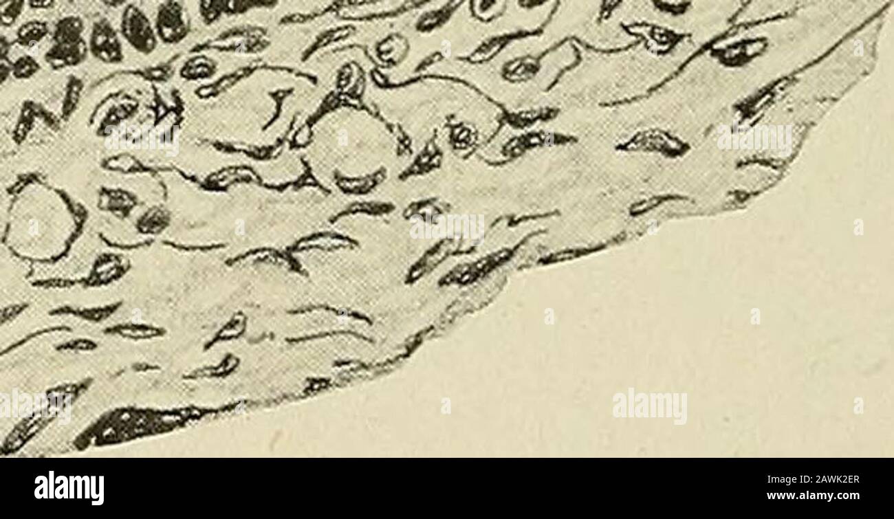 Gynécologie . Fig. 15.—Follicule graafien.[Autour du follicule peut être vu les deux enveloppes de tissu conjonctif, l'extérieur (theca externa) étant fibreux dans le caractère et l'intérieur (theca interna) étant plus cellulaire. L'oeuf est vu des picotements dans l'espace clair entouré d'une masse de cellules épithéliales, le proligerus discus (ou cumulus). Les plusieurs couches de l'épithélium qui tapissent le follicule constituent la granuleuse du souvenir. L'espace transparent crescintique est rempli de liquide séreux, la liqueur folliculi. (Après Veit.) en partie de la petite blessure dans la stigmatisation. Chez les animaux, ce coagulum sanguin est Banque D'Images