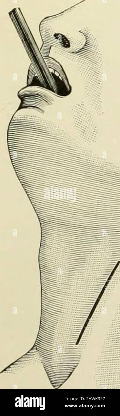 Chirurgie opératoire . e côté; se sentir pour l'étranger, et, s'il peut être localisé, faire la théincision directement à ce point. Si le corps étranger n'est pas perceptible par le toucher, faire une incision d'environ quatre pouces de longueur sur le côté gauche, entrele muscle steruo-mastoïde et la trachée, en commençant à la bordure supérieure du cartilage de la thyroïde (Fig. 765). Le fascia platysmaand est divisé sur un directeur; les bords de la plaie sont séparés, le théomo-hyoïde est tiré vers l'extérieur, et les muscles thésterno- et thyro-hyoïdes vers l'intérieur, ce qui expose la gaine de la carotide, que le vaisseau est tiré vers l'extérieur et retenu •, Banque D'Images