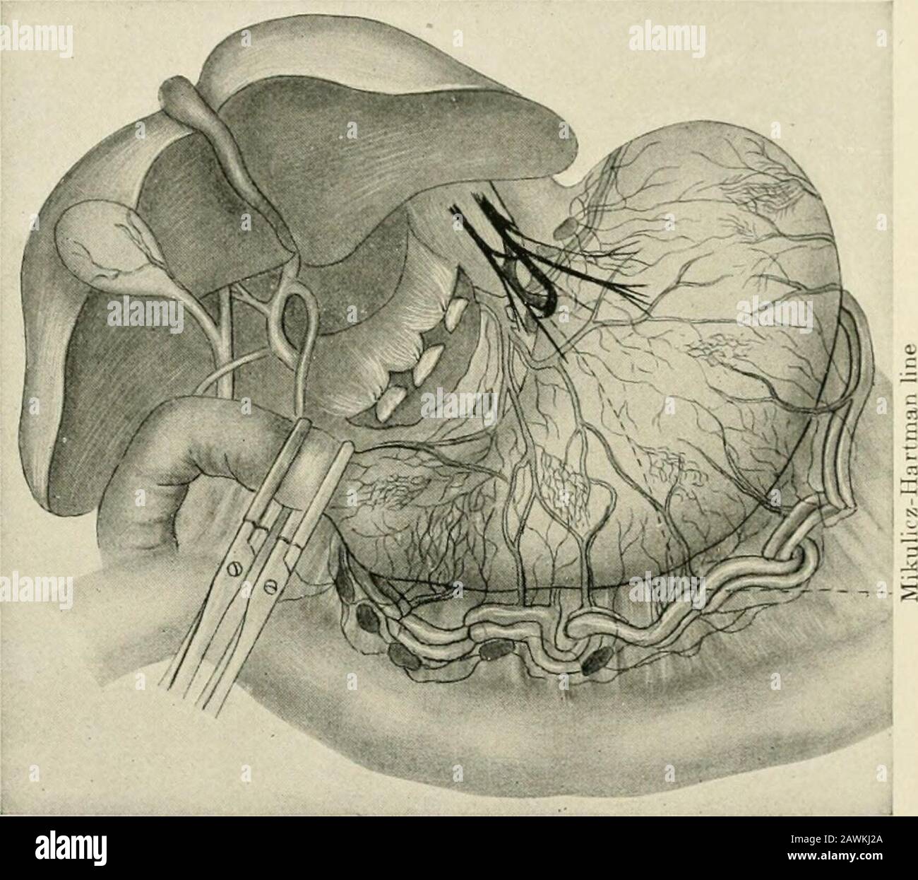 La pratique de la chirurgie . être feltand excisé et le patient recovei, alors qu'un gros et extensie grognon la paroi postérieure de l'estomac peut courir son cours, sans detec-tion, à un arrêt fatal. Si le patient choisit de ne pas avoir fait l'opération, wv doit barrer son véto le rendre composable avec le gasti-ic lavagx;; avec de petits et fre(|alimentation des aliments facilement chggérés, es]lait jectif; avec progressivement ascendant-. Fig. 74.—ligature Sliwing de l'omentum gastrohépatique et des vaisseaux supérieurs de manière à laisser tous les lyni})h-nœuds attachés à la partie de la stomachto excisés; aussi des lignes Banque D'Images