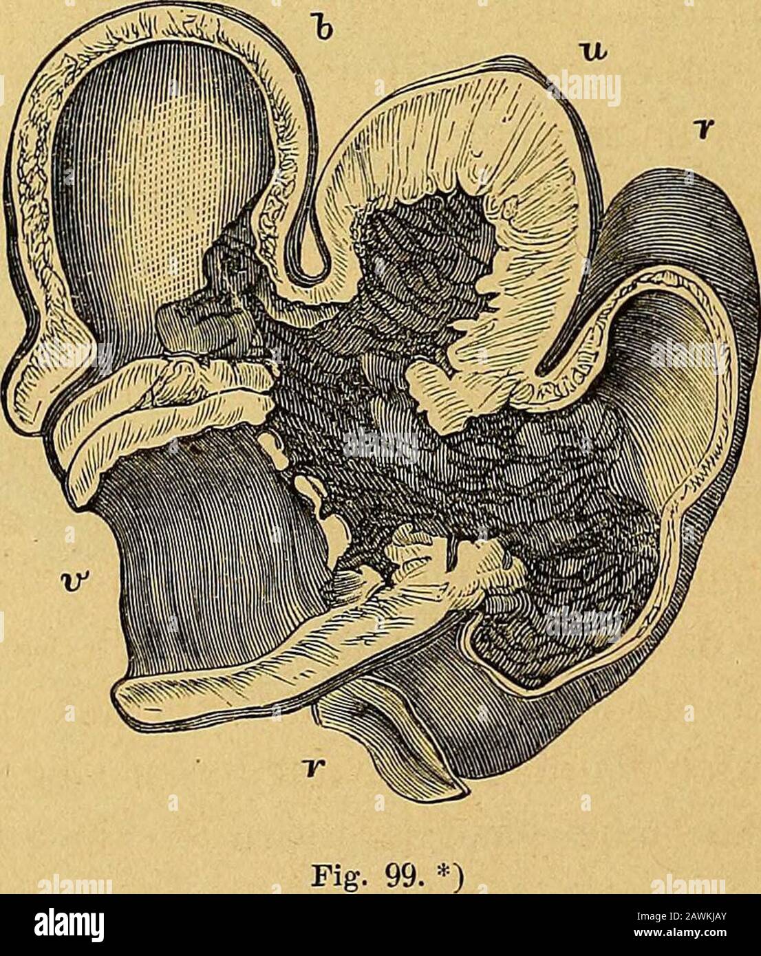 Diagnostic, pathologie et thérapie der Frauen-Krankheiten . erartigeFälle auf 30 von Gebärmutterkrebs kommen. Die Ablagerungkann in die äussere, sub-péritoine oder péritoine Schicht oder indie Uterusfounduz hinein erfolgen. In beiden von Dr. West be-richteten Fällen war die Vergrösserung des Uterus ehr beträcht-liche, indem das orgue in dem einen Falle 6 Zoll masse, während eandern von Kopfgrösse guerre. Vom Utérus aus verbreitet sich dieKrankheit über die angrenzenden Gewebe, und die Drüsen des Beckenswerden afficirt. Nicht selten wistr auch die Blase ergriffen (sieheFig 99) und Hat Banque D'Images