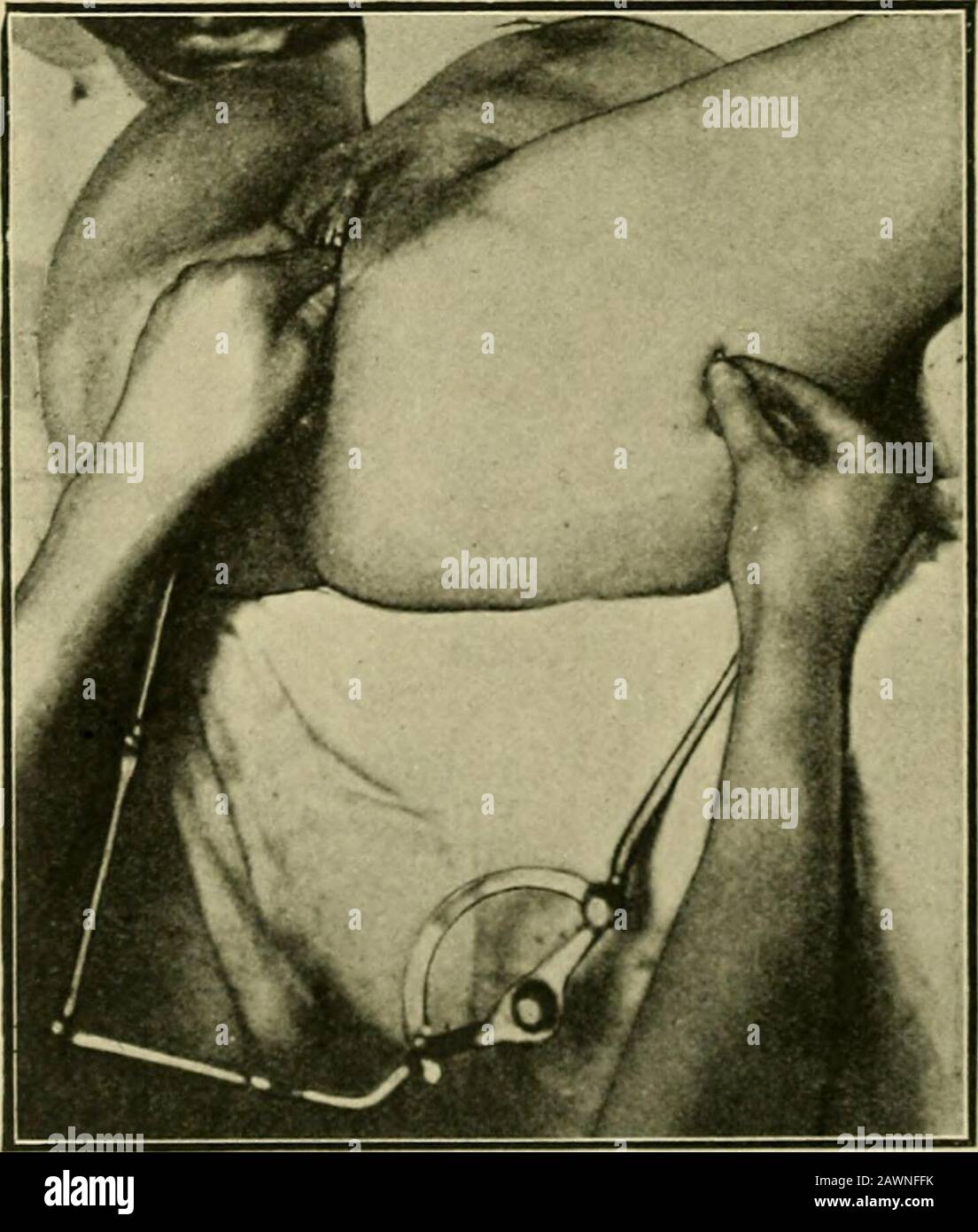 Midwifery opératoire : un guide des difficultés et des complications de la pratique midwifery . FLG. 107.—.mesure de la Conjugata Vera avec le Pelvimètre de Skutschs. D'abord, la distance entre le promontoire et la surface antérieure de la symphysispubis est prise, puis la distance entre la surface postérieure et antérieure, c'est-à-dire l'épaisseur de la symphyse. La différence entre ces deux mesures est naturellement le véritable conjugué. Banque D'Images