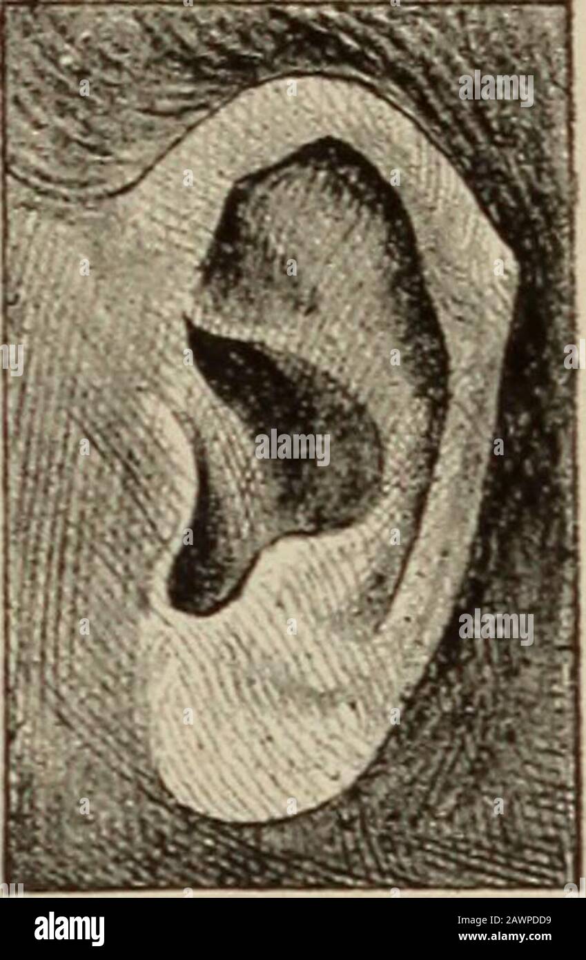 Maladies nerveuses et mentales . Fig. 291.—oreille Stahl, n° 1. Fig. 292.—l' oreille de Darwin. XVIII L'oreille witli trop grande ou trop petite un  concha. X. L'oreille avec la fosse continue scaphoïdea. Les