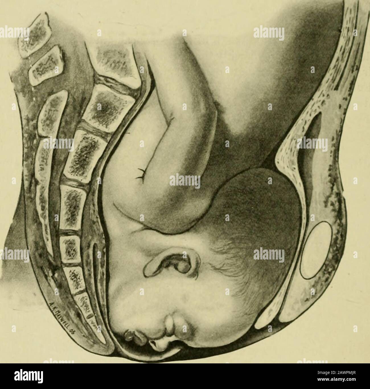 Midwifery opératoire : un guide des difficultés et des complications de la pratique midwifery . es le travail à la nature. C'est entièrement l'attitude du partisan pour Thorn et d'autres pour expliquer les bons résultats obtenus par un traitement purement expectant, comme ceux donnés par Boer et Zeller—120 cas avec seulement six foetalmorts, une mortalité de seulement 5 %.— Et ceux qui ont récemment donné le byHammerschlag,4 avec une mortalité fœtale de seulement 6 %. (89 %. 1 Lehrbuch der Geburtshiilfe, Olshausen et Yeit, 5ème édition, 1902, p. 210. 2 Volksmanns Klin. Vortrdge, N° 74, 1893. 3 Ibid., N° 339, 1 Banque D'Images