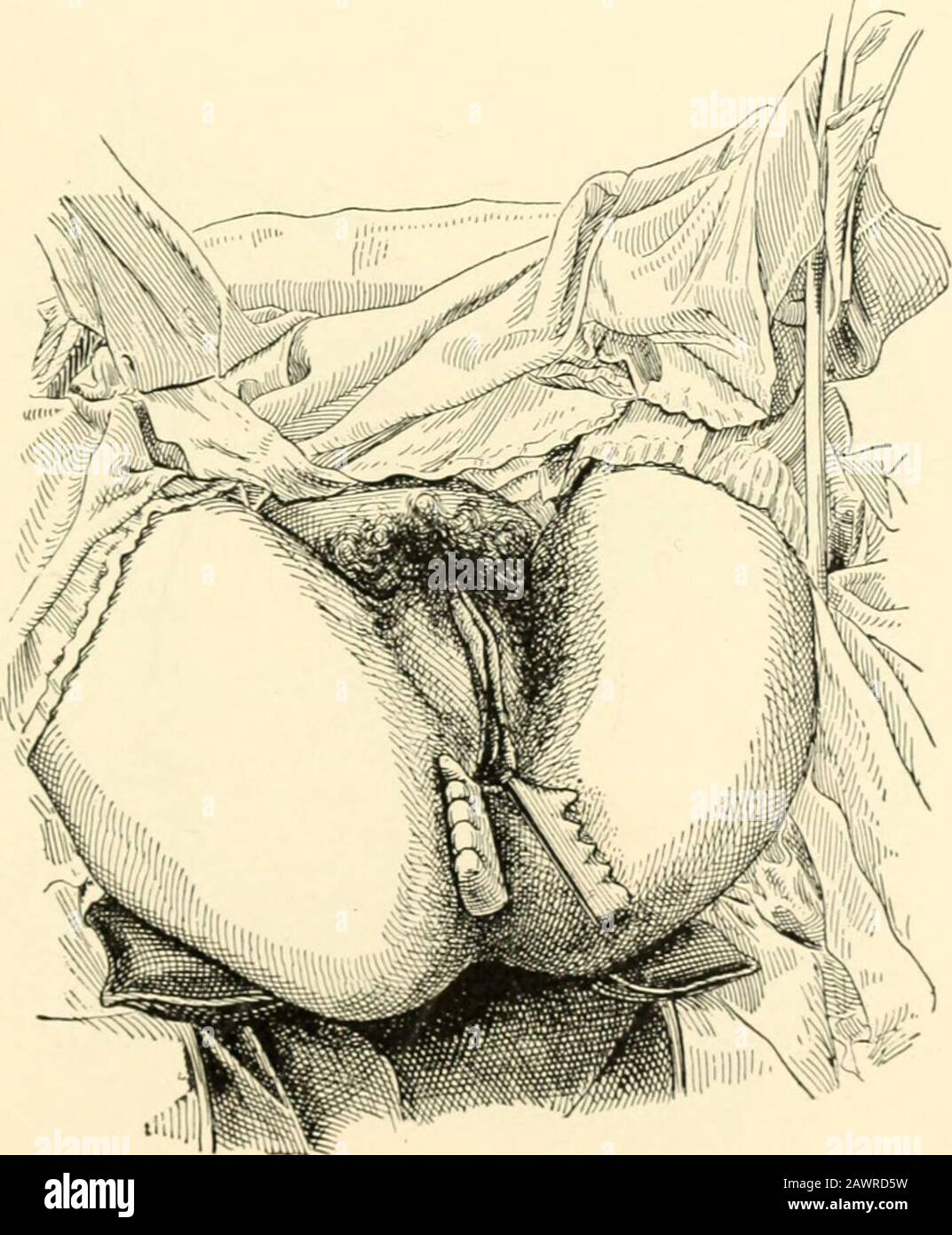 Un manuel d'obstétrique . Fjg. 526.—Insertion de la lame droite, le poignet gauche étant enfoncé pour faire sortir la poignée de la lame gauche du chemin. Fig. 527.—Les Deux lames sont insérées, détournées. 75^ ()BS TE TAH Ou/-;AA TIONS* Banque D'Images