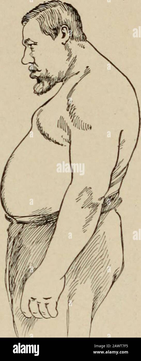 Maladies nerveuses et mentales . le diagnostic peut rarement prétentdifficulté si la maladie a atteint un degré de développement considéré. Myxedema ne montre aucune déformation osseuse, et l'épaississement des parties molles est cireux et boggy. L'arthropathie pulmonaire présente des changements articulaires et un processus chronipulmonaire. L'élargissement clubbed des doigts est largelyconfinée aux phalanges terminaux, au-dessus desquels le nailshang hypertrophique comme le perroquet-bec. Dans l'hyperostose crânii, les mains, les pieds et la mandibule ne sont pas affectés. La maladie de Pagets, ou ostéite déformable, épargne le visage, mais affecte le sk Banque D'Images