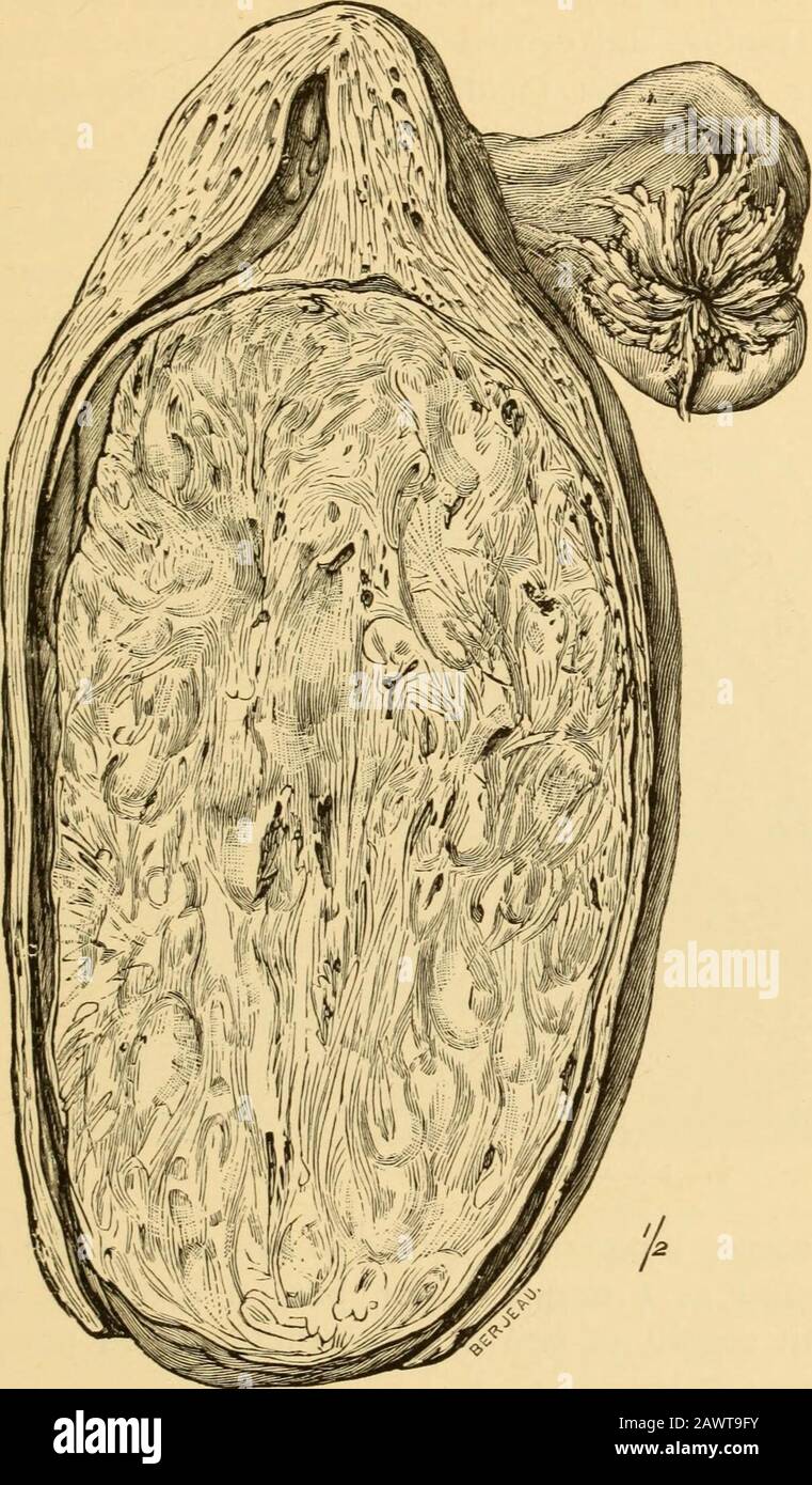 Les maladies des femmes : un manuel pour les étudiants et les praticiens . Fig. 59.—Utérus dans la section sagittale, montrant myomata intramuros et sous-séreux. Et sont fermes et même difficiles au toucher. Les faisceaux de fibres musculaires sont souvent entrelacés de telle manière qu'ils présentent une apparence blantorée caractéristique. Myom-ata apparaissent dans n'importe quelle partie de la paroi utérine (Fig. 59), mais les théyare sont plus fréquents dans le corps ou le fond que dans les MALADIES DE L'UTÉRUS. 183 col de l'utérus (Fig. 60). Il n'y a pas de limite à leur croissance, et. Fig. 60.—myome Intraccervical dans la section sagittale. Ils peuvent atteindre une proportio gigantesque Banque D'Images