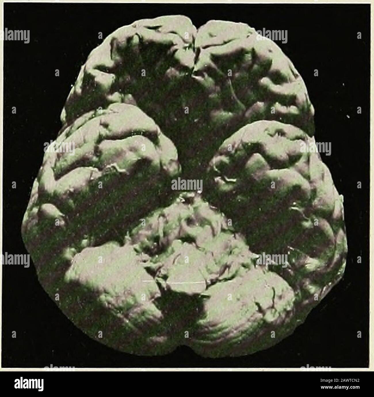 Les maladies médicales des enfants . s peuvent produire l'image ordinaire de la crossedhemiplegia avec l'implication des cinquième, sixième, et septième nerfs.UNE lésion nucléaire du sixième nerf est montré par la perte de conjugatévovement des yeux vers le côté de la lésion. L'hypertrophie des Pons est un nom donné parfois à un diffusigliome des pons. Il y a un élargissement universel des pons, et comme sa forme est maintenue, il ressemble aux pons d'un sultattaché à un cerveau de childs (Fig. 89). Une telle condition est notoirement rare chez les enfants. Les symptômes initiaux dans ces cas peuvent être extrêmement indéfinis Banque D'Images Les maladies médicales des enfants . s peuvent produire l'image ordinaire de la crossedhemiplegia avec l'implication des cinquième, sixième, et septième nerfs.UNE lésion nucléaire du sixième nerf est montré par la perte de conjugatévovement des yeux vers le côté de la lésion. L'hypertrophie des Pons est un nom donné parfois à un diffusigliome des pons. Il y a un élargissement universel des pons, et comme sa forme est maintenue, il ressemble aux pons d'un sultattaché à un cerveau de childs (Fig. 89). Une telle condition est notoirement rare chez les enfants. Les symptômes initiaux dans ces cas peuvent être extrêmement indéfinis Banque D'Images