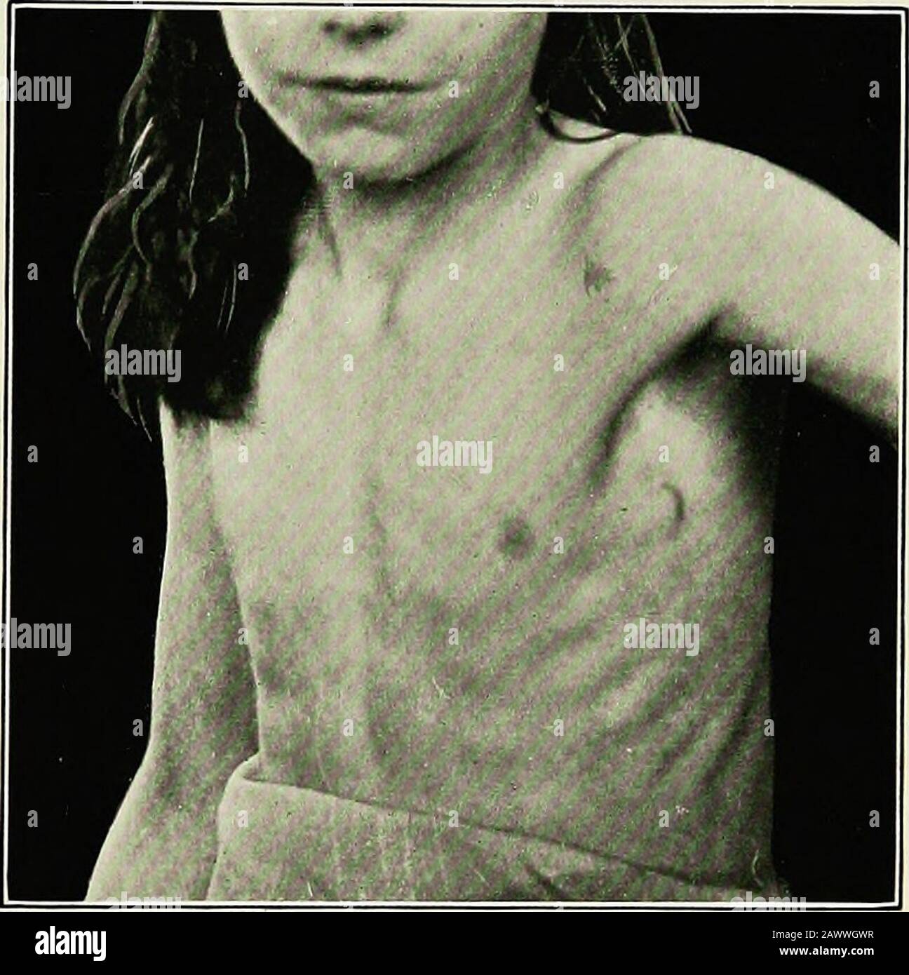 Les maladies médicales des enfants . r. Lorsqu'un enfant a été surveillé par une pneumonie attaqueuse et que l'épanchement pleural se développe sous observation, il est sûr de le diagnostiquer comme purulent. Mais quand, comme c'est souvent le cas, l'enfant est vu pour la première fois après une maladie de semaines, andis puis trouvé avoir une épandu, il est presque impossible d'aller par la théhistoire de l'affaire ; comme on l'a dit, une effusion tuberculeuse peut se manifester soudainement par une forte fièvre, une dyspnée, une toux et une douleur dans le méche, de sorte que ce qui semble être un empyème après la pneumonie, peut facilement se transformer en épanchement séreux. Banque D'Images