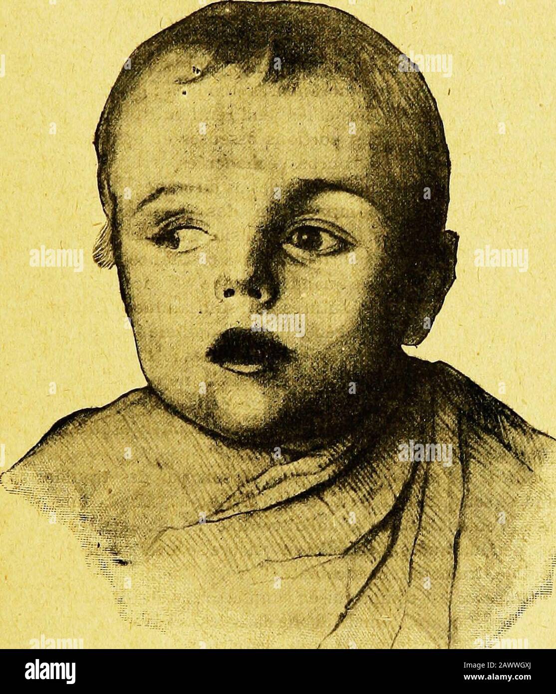 PreÌcis des maladies des enfants . ªme sous-cutanées, dun sumde cheval quelconque, quil soir antidiphtérique, antitènique ouantiméningococcique. Chez de tels sujets, il est prudent demployeur le procédant :on commence par injecter, dans le liquide céphalo-rachidien, i cen-timítre¨cube seullement de sérum ; cette injection Príparante estsursensible, onla vu expérimentement,délect-on¨-legures, lepans, dírlans, dírlans, dírlírlírlírlírlírlírírírírírírírírírírírírírírírírírírírírírír Dans les cas très tombes, où il y a int©rêt à aller vite,on peut encore diminue le temps Banque D'Images