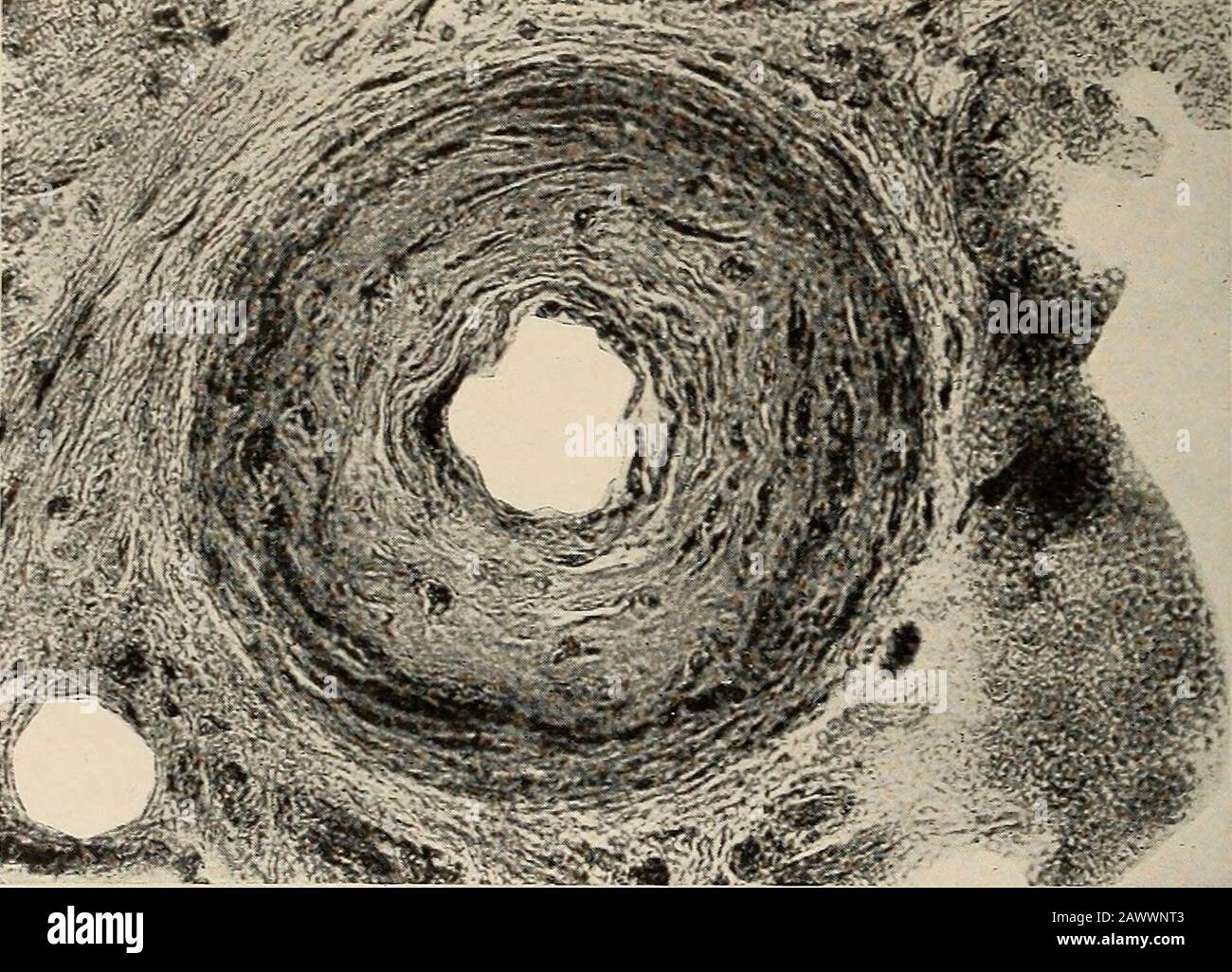 Maladies nerveuses et mentales . les organes ymateux sont perturbés par les canaux lymphatiques. Toutes ces variétés peuvent être trouvées dans le même cas. Cette condition a un certain nombre d'associations pathologiques. Atheromais présent dans environ la moitié des cas. L'hypertrophie et la dilatation cardiaques, la cirrhose hépatique, la maladie des Brights, l'asthme, l'angine de poitrine, la sténose de l'androsthémie sont fréquemment associées et en raison de changements identiques.l'effet de l'artériosclérose est de diminuer le calibre artériel et ainsi diminuer la nutrition. Cela peut atteindre un degré complet et dans le cerveau donne lieu à une anémie localisée et softeni Banque D'Images