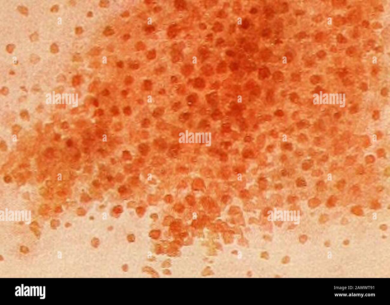 Petechial Banque De Photographies Et D Images A Haute Resolution Alamy Petechial Banque De Photographies Et D Images A Haute Resolution Alamy