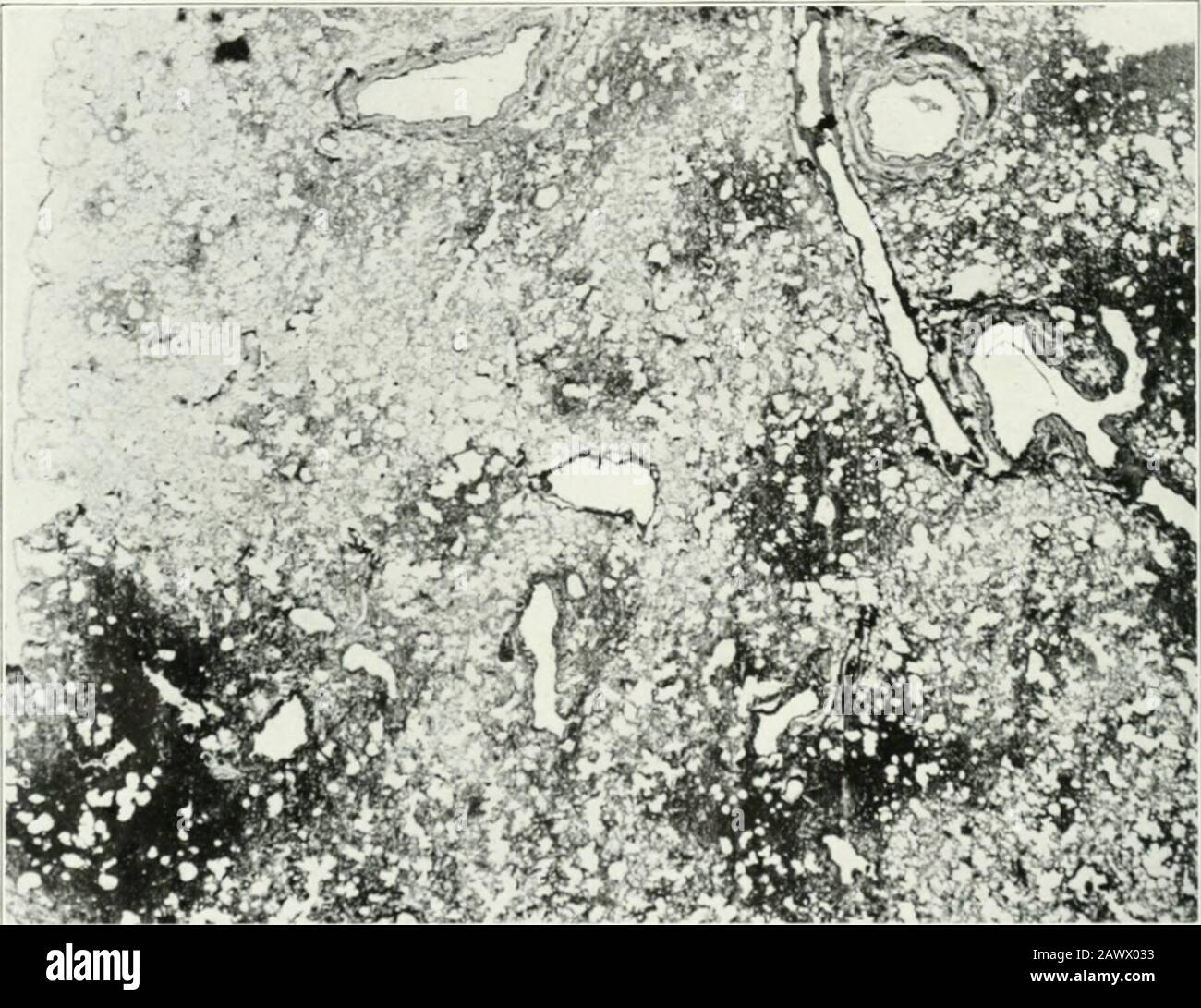 Archives de médecine interne . insuffisance cardiaque. Dans certains cas, le sésediarrhée et l'effondrement sont observés, mais ce n'est pas une forme fréquente d'oftermination. 1. Czaplewski a été en mesure de démontrer la métheiroglobine dans un seul des douze facilite de l'empoisonnement grave, et ce n'était pas un cas fatal. 180 i l!f III l.s de I TEH i /. UEDIC1 E Chez les patients qui ont inhalé de petites quantités de gaz et ont non-provoceaprès l'attaque de Lrrsl d'œdème des poumons, la maladie peut continuer pendant; i nombre de jours avec les symptômes cliniques de bronchite aiguë andevidences dans le chesl de la pneumonie Lobar ou Lobar. Banque D'Images