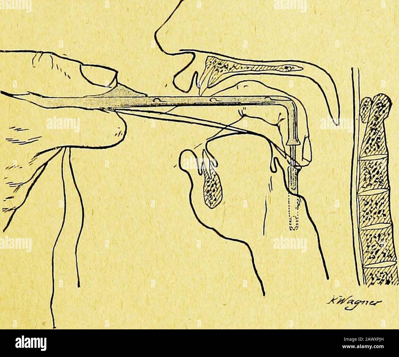 Précis des maladies des enfants . Fig. 3). — les déchets; trisième temps. Médiane et reconnaît avec la pulpe de lindex lépiglotte, lorificelaryngé et les cartilages aryténoïdes, qui le limitent en arrière (fig. 29). ? TRAITEMENT DU CROUP. 133 Puis, de la droite principale, il introduit le tube et fait suivre à lextrmitéde ce tube le bord externe de lindex gauche resté en position ; le tube. Fig. 32. — les toubage; la quatrième temps. Arrivent ainsi à lorifice du larynx (fig. 30) ; verser introduire, il Banque D'Images