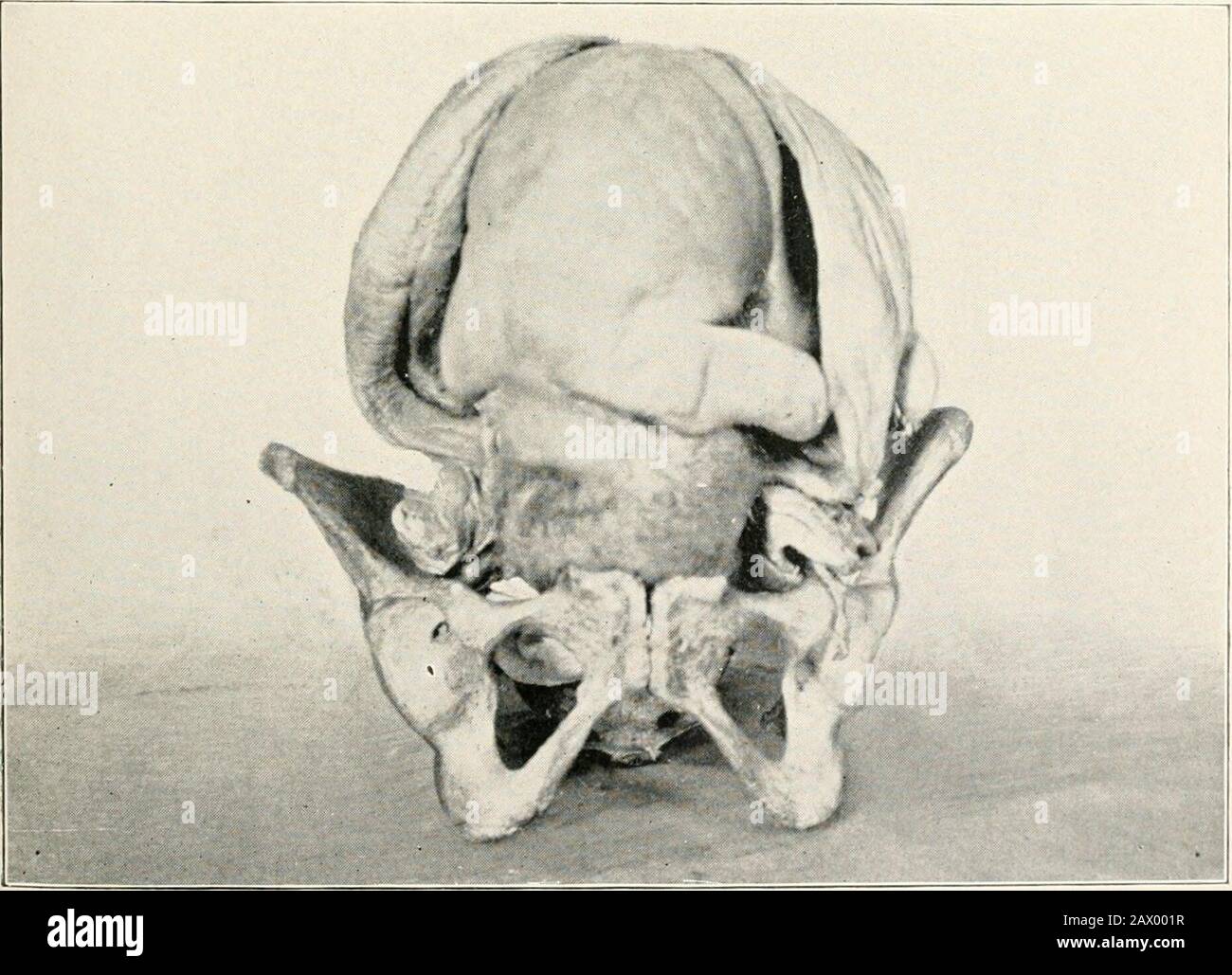 Un livre de texte d'obstétrique pratique, comprenant la grossesse, le travail, et l'état puerpal, et la chirurgie obstétrique . Présentation du Vertex. Occiput Gauche Antérieur. Présentation du Vertex. Occiput Droit Antérieur. MÉCANISME DU TRAVAIL. 107 la flexion et la descente sont semblables dans le mécanisme à celui qui est juste noté pour la position L. O. A. la rotation diffère seulement dans ce qui afin d'amener l'occiput sous les pubes la tête doit tourner vers l'avant le long du plan latéral droit du bassin. La tension se produit comme dans le cas de la position L. O. A. rotation externe, orrestitution, amène l'occiput pointant vers le Banque D'Images