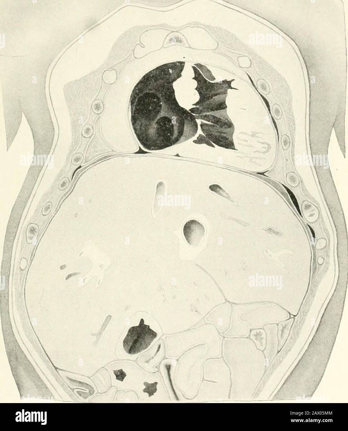 Tuberculose clinique . Fig. 53.—Illustrant les ordres ioniaux des poumons, antl l'emplacement des interlobularsejiti. Vue latérale. A, droite ; B, gauche. (Corning.) est généralement donné comme ayant lieu sur un niveau avec la jonction du deuxième cartilage costal avec le stermnn, mais à partir des données quotedau-dessus de sa i)osition doit bo varialjle. (Voir pages 326 et 327.) Les Muscles Utilisés dans la respiration normale.—Le mouvement de la paroi thoracique par defi-cient est un accompagnement très important et presque cohérent de l'inflammation dans les poumons et la plèvre; et, autant que quelques perturbations de la part de Banque D'Images