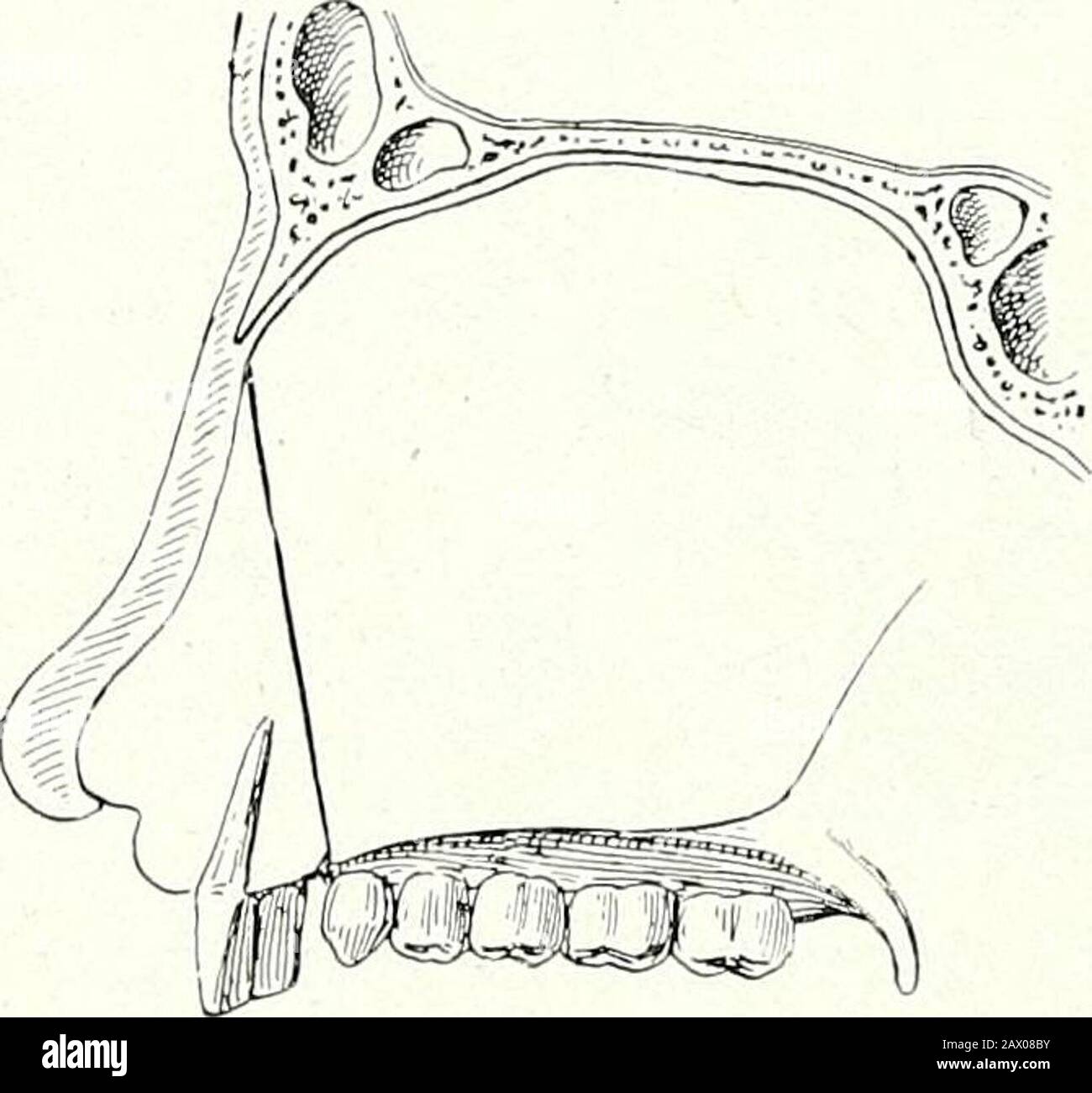 Thérapeutique chirurgicale et technique opératoire . Fig. 26.—Lièvre-Lèvre Bilatéral. Projection exagérée du tubercule incisive ; résection défectueuse du septum nasal. Fig. 27.—Lièvre-Lèvre Bilatéral. Déviation Jackward de l'incisor des dents après la résection triangulaire du septum nasal. Banque D'Images