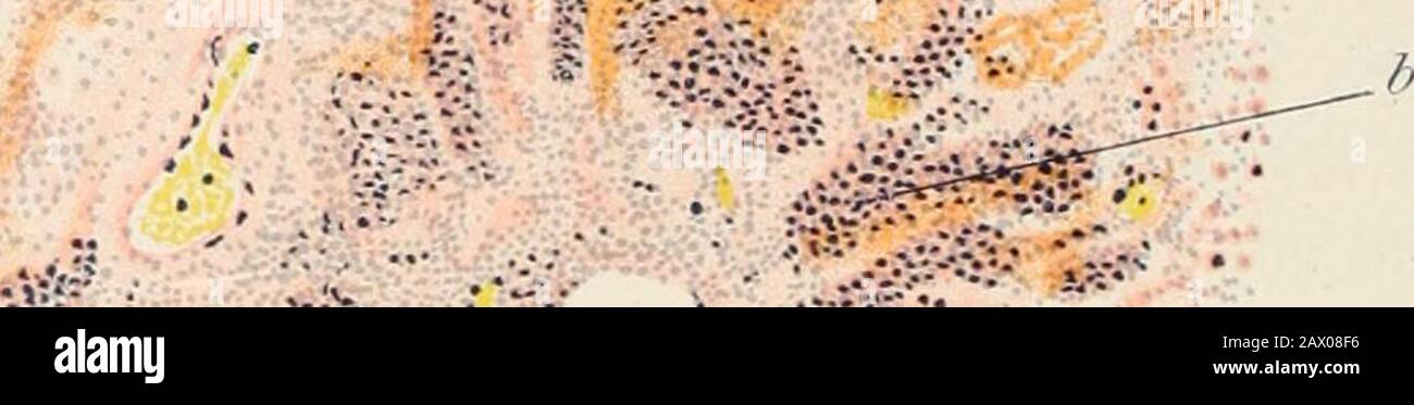 Pathologie pratique; un manuel pour les étudiants et les praticiens . dans ses espaces lymphatiques. La zone étroite immédiatement autour de la bronche, les vésicules sont remplies wiih une masse semi-transparente de fibrelles délicates et cellules, ce qui diffère de l'exsudation dans le stagede l'hépatotisation rouge de la pneumonie aiguë du lobar seulement dans le fait qu'elle contient un grand nombre de cellules. Là où le tliis [la secoue n'est pas de longue date, les thewalles de l'alveoli sont épaissies en raison de la distension des capil-laries; près de ces capillaires, un certain nombre de cellules plus grandes sont usuyelytrouvé dans la vésicule d'air. En dehors de ce nar Banque D'Images