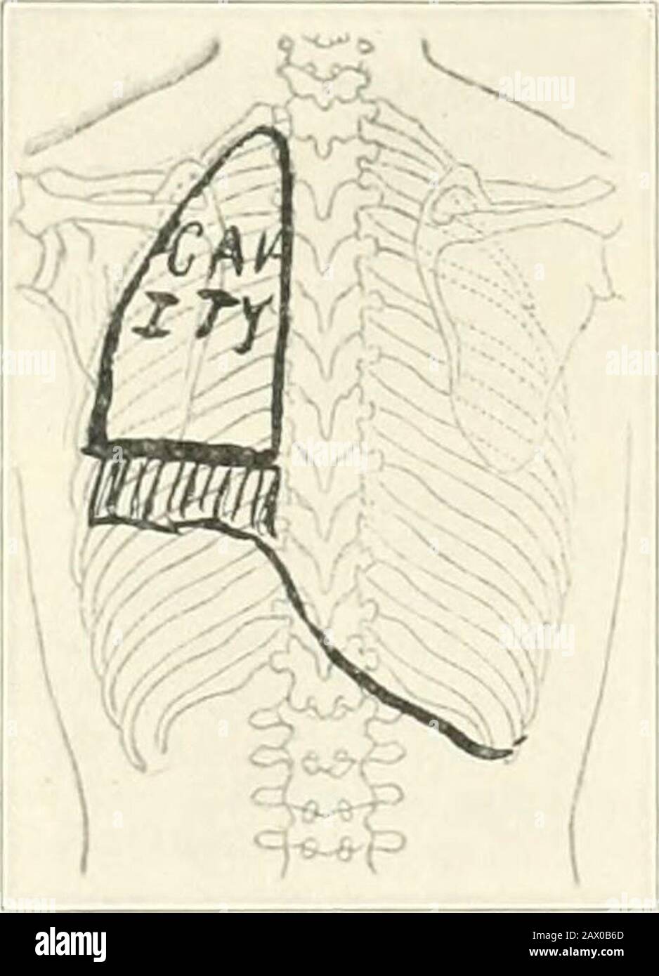 Tuberculose clinique . Fig. 48.—Montrant une compensation schématiquement de tlie qui a pris de l'iilace entre les côtés de la poitrine et entre les cavités thoracique et abdominale. A. vue antérieure;B, vue postérieure. Le cas ILLUSTRATIXG A MARQUÉ UNE COMPENSATION 311 par conséquent, réduisant le ton des vaisseaux. L'exercice normal exige une quantité de sang supplémentaire, et c'est sniplod des réservoirs veineux, en particulier ceux de la zone splanchnic. Maintenant, en raison de la puissance inspiratoire de la deficientspirap possédée par ce patient, elle n'est pas en mesure d'asjjirate le sang des veines dans le coeur droit et fournir Banque D'Images