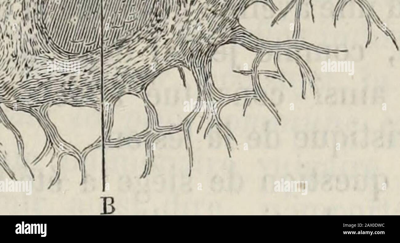 Nouveau dictionnaire de médecine et de chirurgie . 1 l 3 M «JU. ^VSTTi. FIE 47.— A. A Granulations grisées du poumon compositions dun certains nombres de tuberculeslémentaires iudés par les cellules géantes B. B. Lagranégat peut contenir deux, trois, quatre fois plus de tubercules élés-mentaires; Ou pendentif que le volume augmente ainsi, la dégénérescecaséeuse sacense progressivement, et ce nest plus la granulation miliairede Bayle quon a sous les yeux, cette granulation si bien caricatérée par Laënec : « cette variante rare des tubercules , remarquable suruniforme par « Banque D'Images