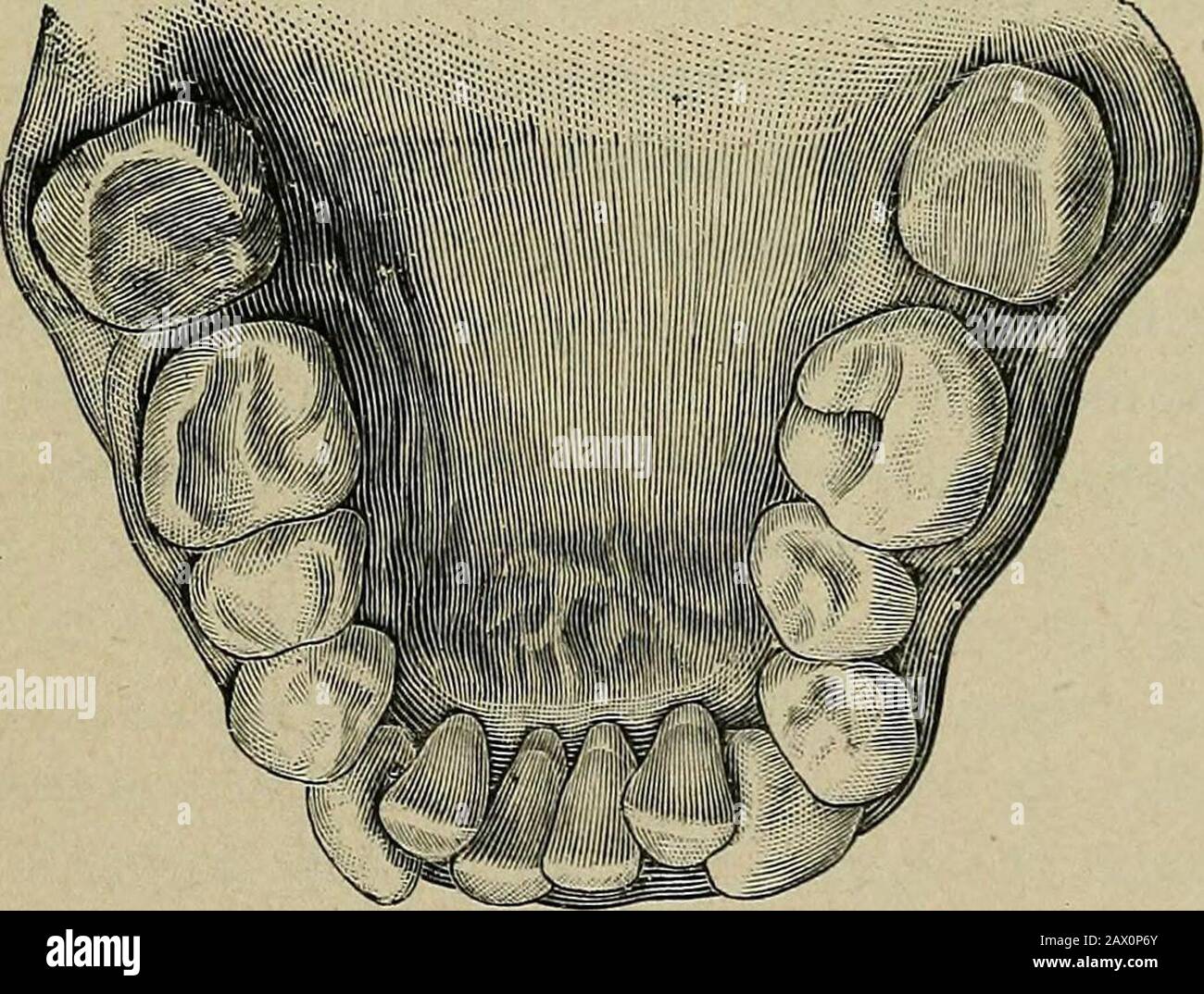 L'étiologie des déformations osseuses de la tête, du visage, des mâchoires  et des dents . Fig. 173. Fig. 174. Les dents se développent normalement,  mais le deuxième bicuspide est eitherretardé dans son
