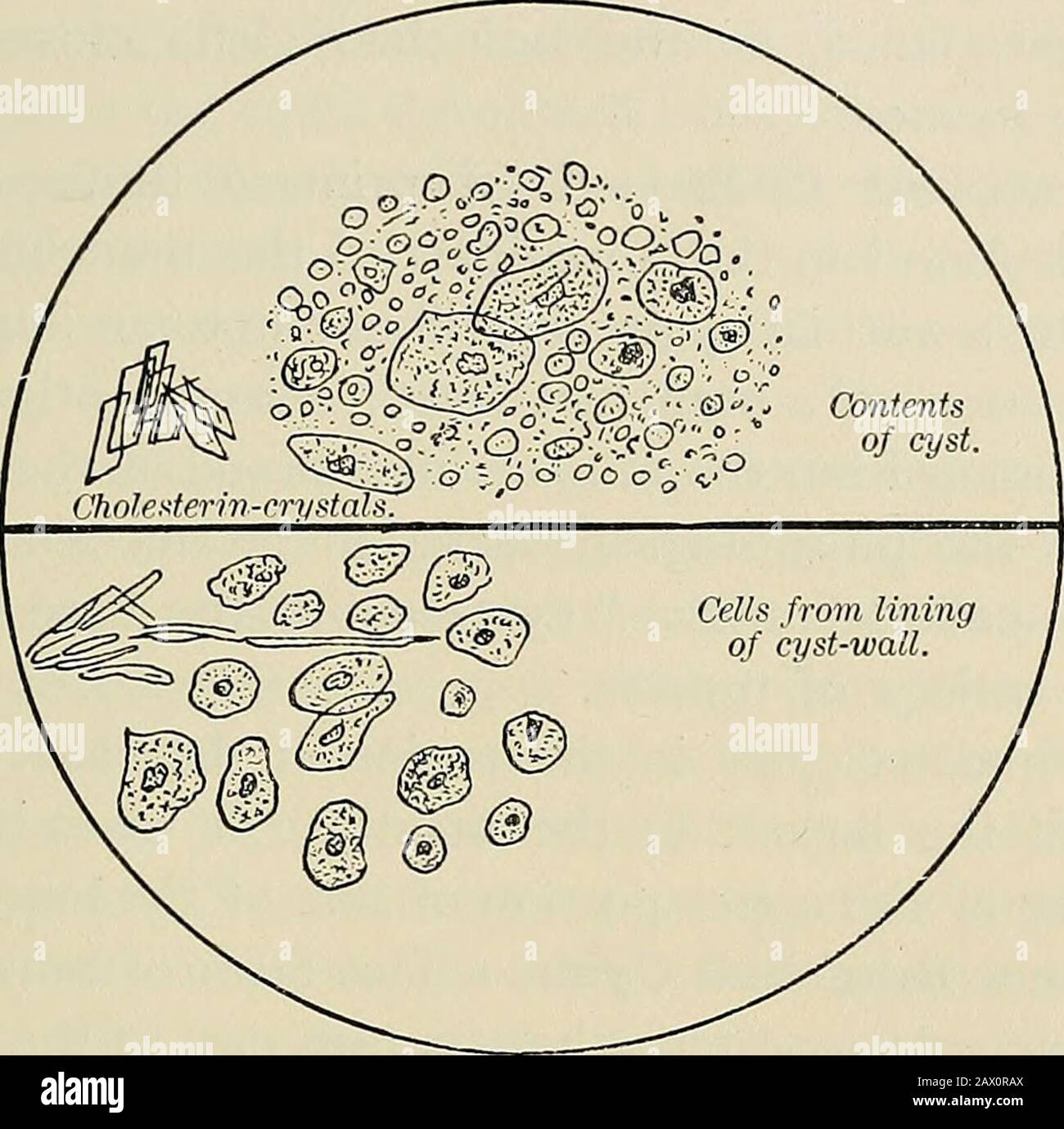 La pathologie et le traitement chirurgical des tumeurs . tentes du kyste. Tissu nécrosif doublé à l'intérieur avec les cellules épithéliales. Dans la plupart des instances  LW AT  , l'épithélium qui tapisse la paroi du kyste et qui se trouve dans le kyste-contentsreprésente l'épithélium de la peau (Fig. 446); mais Rehn a découvert, dans une fistule congénitale aveugle se terminant près de la muqueuse du thépharynx, épithélium cilié, qui, bien sûr, doit avoir été dérivé du pharynx. Neumann a trouvé cylindrique et pavé épithe-lium dans deux tumeurs cy.stic du cou ; l'une des tumeurs était con-génitale, tandis que l'autre a été développé l'année suivante Banque D'Images