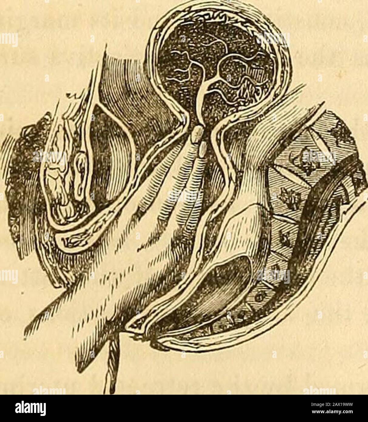 Un traité théorique et pratique sur la midwifery : y compris les maladies de la grossesse et de la parturation et les attentions requises par l'enfant de la naissance à la période de sevrage . ouverture arrondie, l'orifice de thecell à travers lequel le cordon passe; et au-delà, ce sont les murs irréguliers du thecyst, qui inculperont le placenta. Ici aussi, l'accucheur devrait attendre, si l'enkystement n'est pas complicatedpar un accident; s'efforçant, cependant, en moyenne, de favoriser le retour de Fio-. 135. l'utérus à sa forme normale, par un recours aux mesures avant de les conseiller. Lorsqu'un dan-ger menace le Banque D'Images