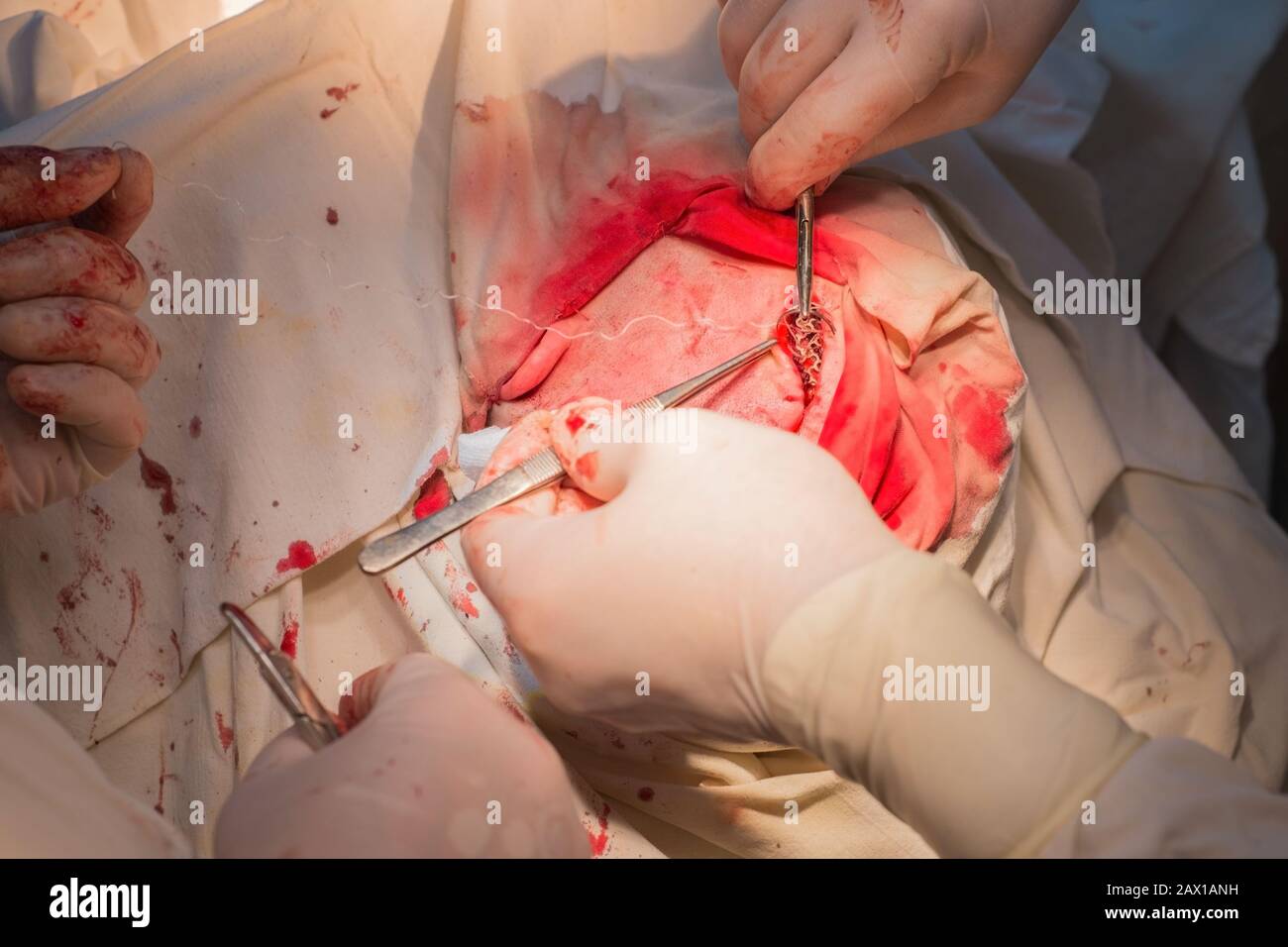 vue de dessus, étapes de la chirurgie neurochirurgicale pour l'installation d'une plaque en titane dans le crâne du patient. Neurochirurgie pédiatrique. Craniotomie. Incision des s Banque D'Images