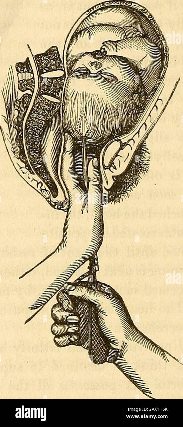 Un traité théorique et pratique sur la midwifery : y compris les maladies de la grossesse et de la parturation et les attentions requises par l'enfant de la naissance à la période de sevrage . branche opposée, et limite son mouvement dans une direction, tandis que le printemps c, le limite dans l'opposieone. Les deux branches sont articulées d'une manière propre à M. Charriere (dtenoti), qui admet qu'elles sont facilement démontées. Le patient placé dans une position appropriée, l'opérateur saisit l'instru-ment par sa poignée, avec sa main droite, et l'introduit à la tête du fœtus en le passant alo Banque D'Images