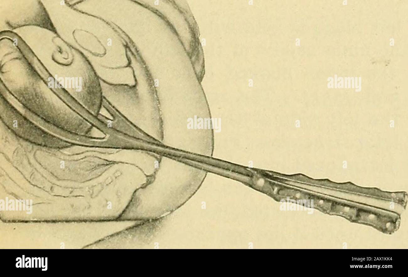 La pratique de l'obstétrique, conçue pour l'utilisation des étudiants et des praticiens de la médecine . Fig. 1206.—-application Pelvienne des forceps, a, a, pression exercée par le bord inférieur de la lame droite sur le crâne du fœtus; b, b, pression exercée uponthe crâne du fœtus par le bord supérieur de la lame de theleft. Fig. 1207.—application céphalique des laforceps, ou adaptation, b, lame gauche.la lame droite est introduite en face de la sycondrose sacro-iliaque theright à a, et transportée avec les doigts internes à a.. Banque D'Images