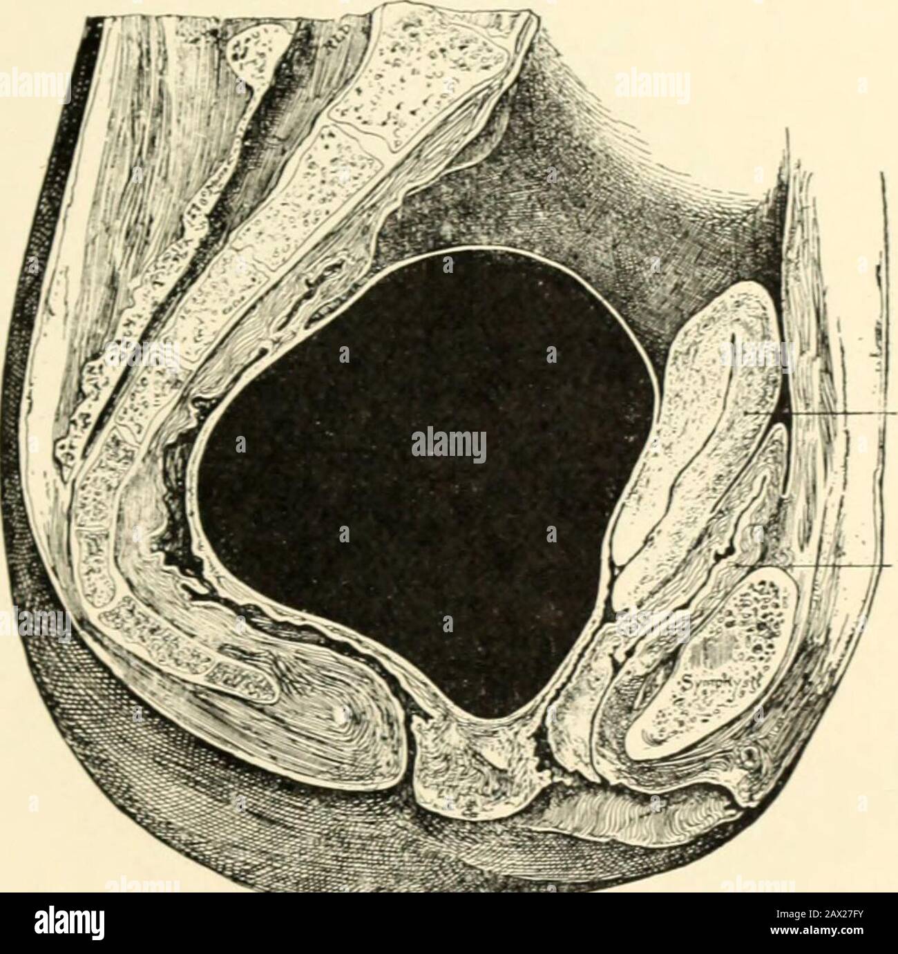 Un manuel d'obstétrique . Les incases de rupture apparemment de ce caractère n'ont peut-être pas eu lieu.Il peut y avoir eu une croissance rétropéritonéale de l'ovum andan énorme dilatation des parois tubaires. La croissance et le développement du placenta après la mort fœtale hasété décrit, mais n'a pas encore été démontré au-delà. Utérus Bladde Fig. 177.—Schéma montrant l'hématocele pelvien postérieur à l'utérus, le siffleur bondit vers l'avant avec la vessie derrière la symphyse pubis, alors que le rectums se comprime derrière contre le sacrum (Skene). Doute. Il semblerait impossible, arguant du comportement de l'apl Banque D'Images