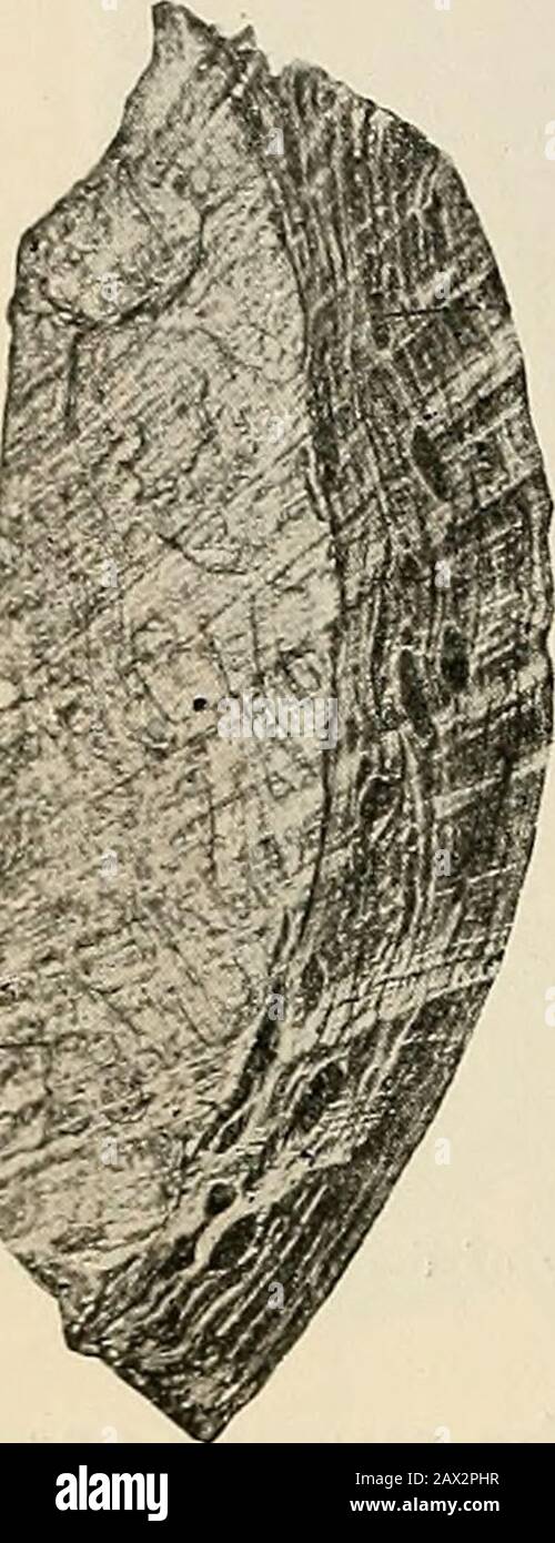 La pathologie et le traitement chirurgical des tumeurs . Fig. 347.—Myofibromata Multiple de l'utérus et du ligament large (après Winckel) : a, ovaire droit ; b, tube Fallopien droit ; c, myome interstitiel ; d, myome sous-mucus ; e, myome sous-séreux ; f, orifice de l'utérus ; g, myome interstitiel ; h, myome intraligementous. Les tumeurs interstitielles — ou, comme on les appelle aussi, intrapariétales — peuvent se faire au niveau de n'importe quelle partie de la paroi utérine. Un emplacement fréquent est près du col de l'utérus (Fig. 344). Une autre localité préférée est au fond (Fig. 345). 488 PATHOLOGIE ET TRAITEMENT DES TUMEURS. Peu fréquent sous-péritonéal et sous-zu Banque D'Images