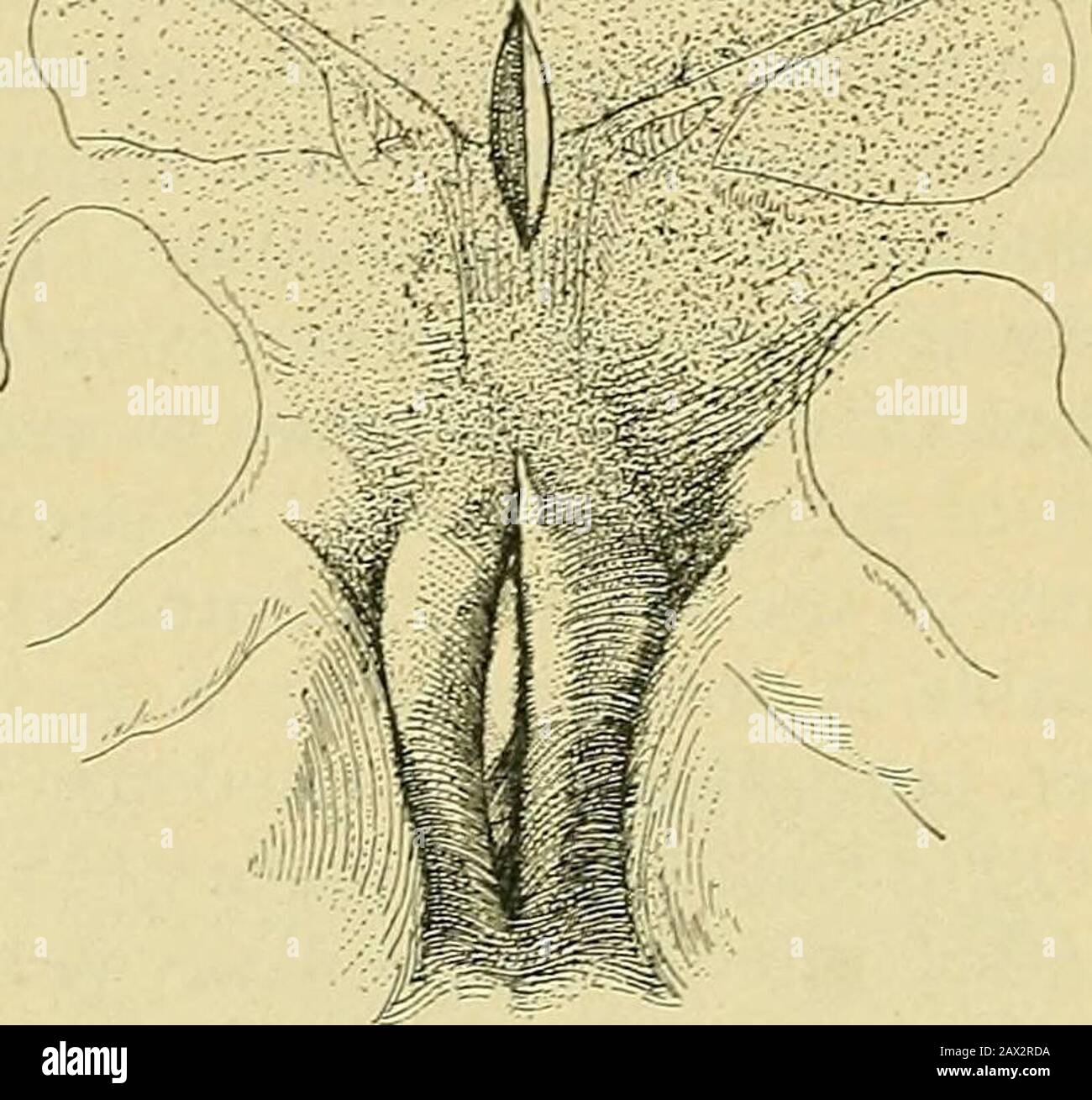 La pratique de l'obstétrique, conçue pour l'utilisation des étudiants et des praticiens de la médecine . om derrière vers le haut et de dessous vers le haut, la thessymphyse est divisée. Morisani attend alors l'expulsion spontanée, et si ce n'est pas à venir les forceps est appliqué. L'incision cutanée est alors réappariée et un pansement immuable de plâtre de Paris ou de silice est appliqué sur le pelvis. La méthode Novis est pratiquement la même, sauf qu'il utilise un bistouri au lieu d'un couteau Galbiatis. Il s'applique après l'opération une simple spica ^bandage, non renforcée de quelque manière que ce soit. Un symphyséotome spécial a été de Banque D'Images