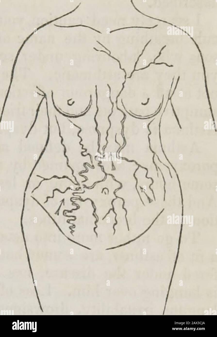 Les conférences sur les principes et la pratique de la physique : données au King's College, Londres . ish a test, étaient d'autres jetons voulant, par lequel déterminer quelle est l'obstruction qui se trouve dans la cava supérieure ou inférieure. Et il y a des circonstances anothermiques dignes de remarque, et dont la même utilisation pourrait être faite. Dans le premier cas, les veines dilatées du thorax étaient tortueuses, celles de l'abdomen direct. Dans le second, elles étaient inversées; les veines épigastriques étaient singulièrement sinusoïes, les veines thémateuses étaient droites. En d'autres termes, ces veines étaient, dans chaque cas, contortées et sinueuses, dans lesquelles Banque D'Images