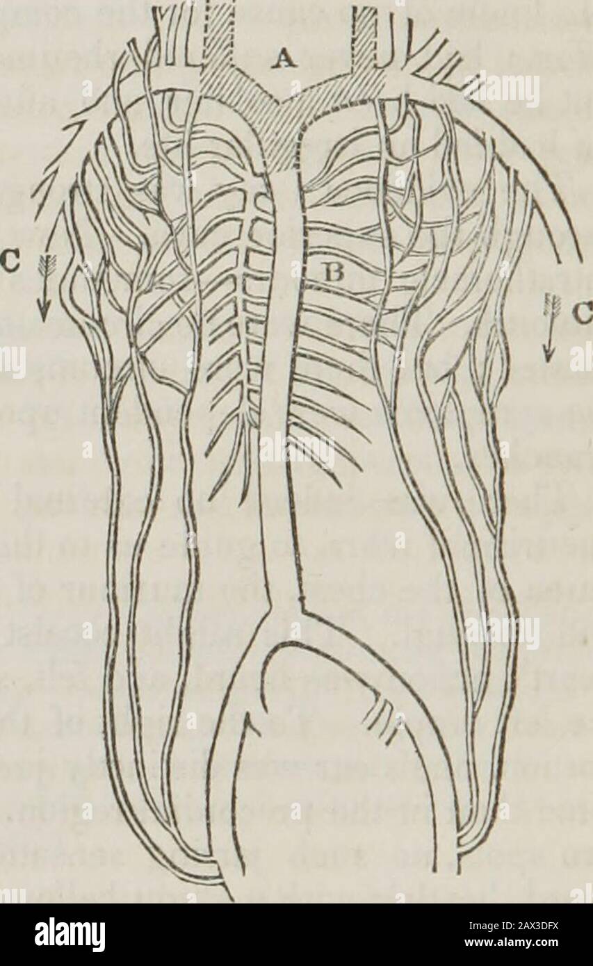 Conférences sur les principes et la pratique de la physique : données au King's College, Londres . A, veines Obstruées. B, siège de l'auricule droite. C, les veines thoracique, pectorales et mammaires transmettent le sang dans un cours contraire à son usualDirection, et anastomosing avec les veines inter-costales et épigastriques. Alors que les veines dans lesquelles les troncs des vaisseaux absorbants distraient leurs tentes étaient oblitérées, il est devenu intéressant d'examiner l'état de ces vaisseaux, et des glandes lymphatiques. Mais la condensation et la confusion de toutes les parties autour de la tumeur ont rendu difficile à tracer Banque D'Images