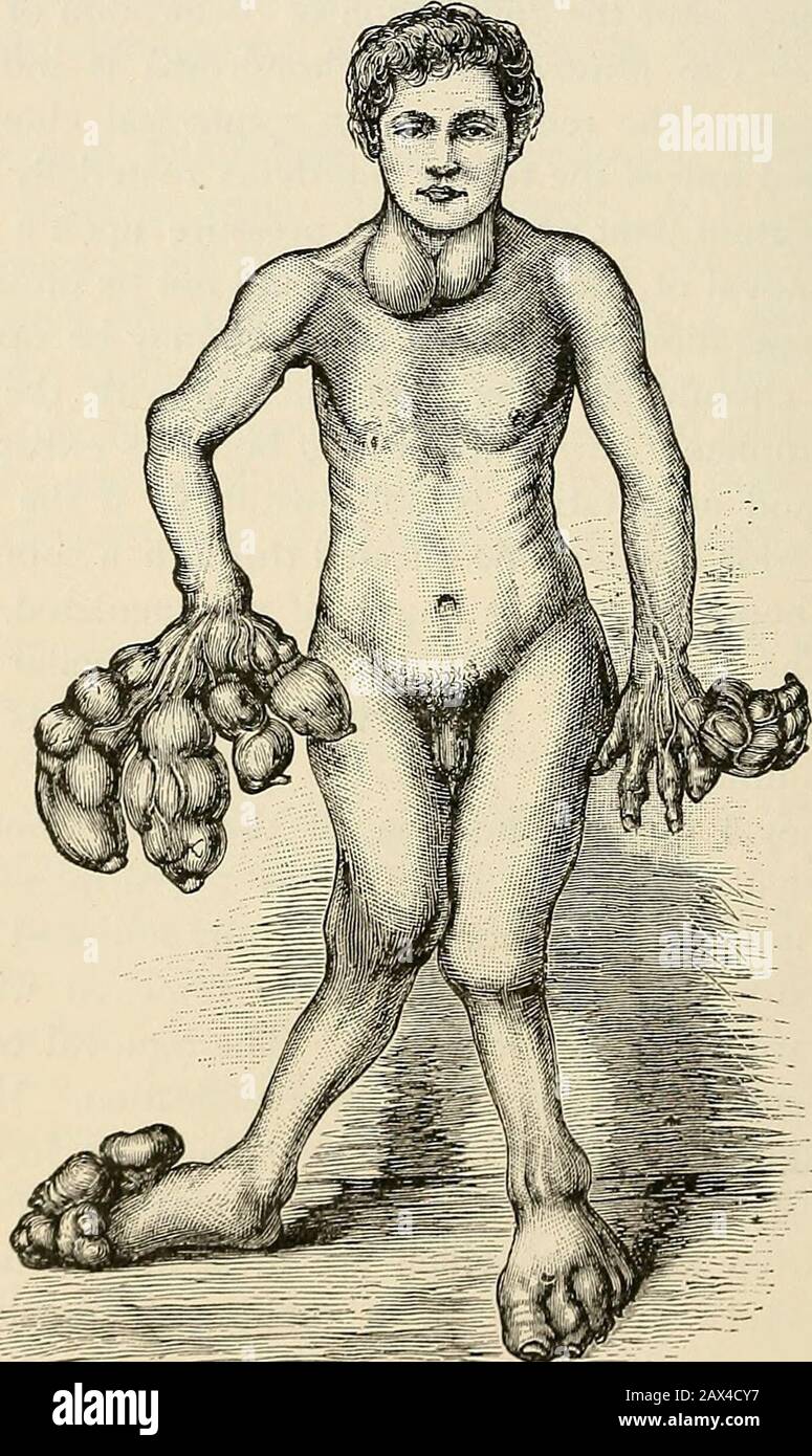 La pathologie et le traitement chirurgical des tumeurs . s d'une transition maligne, les mesures mostradiques doivent être appliquées, en éliminant non seulement le thétumor, mais aussi les tissus infectés adjacents. Topographie. Chondroma se produit le plus fréquemment en relation avec les os et les organes situés dans une localité où le déplacement des chondroblastes est le plus susceptible de se produire. Une matrice post-natale ne peut se produire que dans les tissus produisant des os, dans les os et dans le périostéum. Cartilage.—la surcroissance du cartilage Virchow appelle ecchondro-sis. Des ecchondroses localisées se produisent dans quatre localités préférées, à savoir 422 PATHOLOGIE ET Banque D'Images