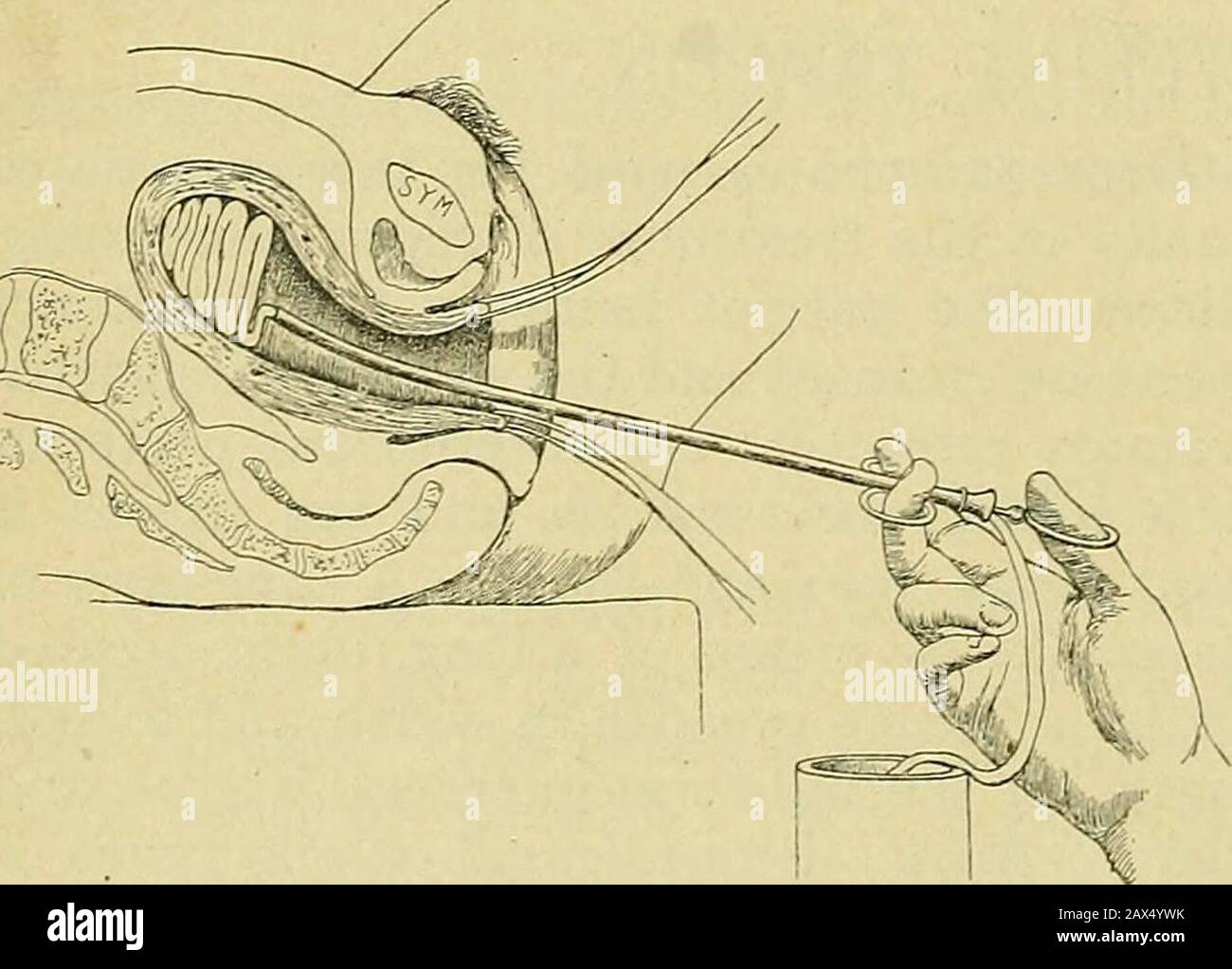 La pratique de l'obstétrique, conçue pour l'utilisation des étudiants et des praticiens de la médecine . Fig. 1061.—méthode d'emballage de l'Utérus puer-peral.—(À Partir d'une photo.) Fig. 1062.—méthode d'emballage de l'Utérus Puerperal. Segment, comme dans certains cas de placenta praevia ou lacération cervicale, l'emballage vaginal devrait être serré. Dans certains cas, l'utérus peut être enfoncé jusqu'à présent qu'il n'est pas nécessaire de l'abaisser au moyen de l'In-struments, et si le dernier areliking, la gaze peut usuusyêtre introduite au moyen de la main étant passée dans la cavité utérine. Si la gazéine stérile n'est pas à portée de main, clea Banque D'Images