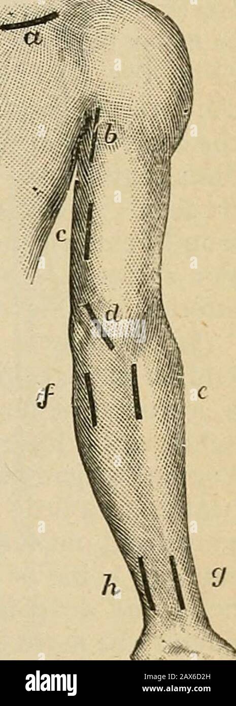 Chirurgie; sa théorie et sa pratique . LES ARTÈRES IAL ET ULNAR peuvent être liées pour I, anévrisme de ves-sel ou, 2, blessure de l'arche palmaire ; mais il est question de savoir si la ligature de la brachiale n'est pas préférable dans le cas de la projection, car l'anastomose entre les artères radiale et ulnaire et les artères interosseuses est ramollie (Fig. 102). Les deux artères dans le cas d'une blessure de l'arche palmaire doivent être liées. C'est mieux fait au thézoriste, où ils sont superficiels et peuvent être sentis pulsating. Les mensonges radiaux sont entre la longue du supinateur et la flexor carpi radialis ; l'ulnarentre l'intérieur Banque D'Images