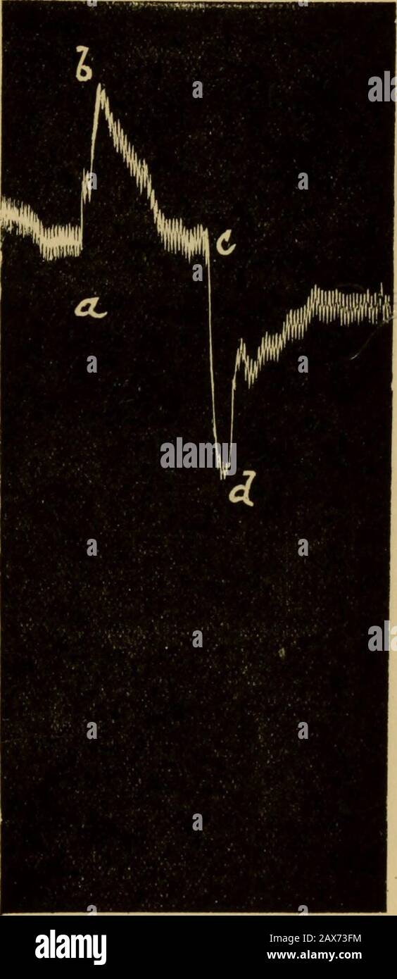 Injection intraveineuse dans le choc de la plaie : étant les conférences Oliver-Sharpey données avant le Royal College of Physicians de Londres en mai 1918 . essellées par les produits asphyxiaux des tissus, EN CHOC DE LA PLAIE 135 parce qu'il pourrait y avoir très peu de circulation dans le membre avec la veine clampée. C'était l'effet d'acapaité, dans la grandeur. Il y avait, comment-jamais, des méta-bolites dilatateurs qui passaient dans la circulation générale, comme le montre l'effet morépermanent. Dans une autre expérience, j'ai eu la preuve de la dilatation des intestins, mais il était difficile d'en être certain Banque D'Images