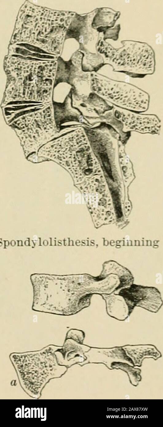 Le livre américain d'obstétrique pour les praticiens et les étudiants . FLG. ::.—Spondylolisthesis, bien marqué (Schauta). Porc. 34.—Spondylolisthèse, Début (Sehautai Pig. :v>.—les dernières vertèbres lombaire de la spondylo-listhrite (A) contrastées avec une vertèbre normale de la barre lum (Neugebauer . segment articulaire de l'arche spinale et les pédicules sont enormencellées de derrière l'avant et sont courbées à un angle de wan 1 i Fig.35). Après un certain temps, ce segment peut présenter une fracture transversale ou une asvolution de continuité à partir de la pression et de l'attrition. La déformation est alwaysprogressive dans le développement. Banque D'Images
