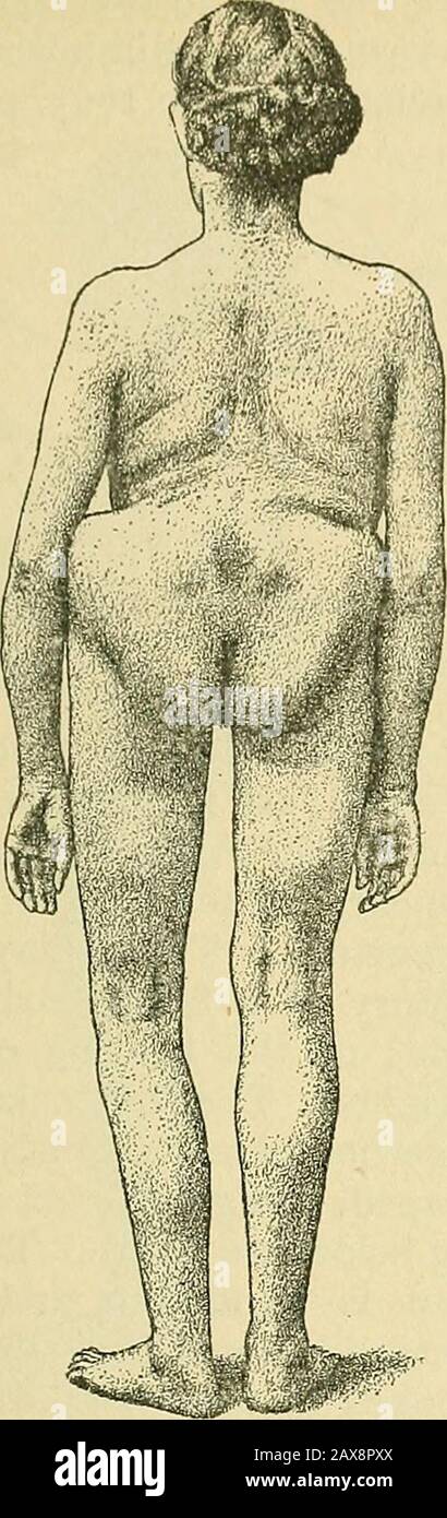 La pratique de l'obstétrique, conçue pour l'utilisation des étudiants et des praticiens de la médecine . ed (Fig. 857). La diminution de l'inclinaison pelvienne entraîne une contrainte anindue sur les ligaments ilio-fémoraux. De cette façon, les tuberosi ischiaux sont rapprochés plus que la normale, tandis que les crêtes de l'éruption ilia.Naturellement les épines supérieures postérieures de ces os font également flamber. Le ribsand le bord du bassin se rapproche et la hauteur du patient diminue. Le diamètre transversal de la sortie est réduit alors que celui de l'entrée est augmenté. Sur l'examen interne le conju-gat Banque D'Images