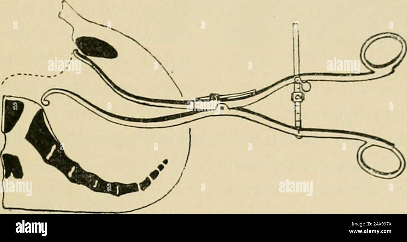 Le livre américain d'obstétrique pour les praticiens et les étudiants . irmly a mis le pélvimètre ayant été placé que l'indicateur est tourné vers l'examinateur, la mesure isdonc facilement lu dès qu'a^ le pélvimètre est dans la bonne position. ITC en moyenne, chez les femmes bien construites, 20^ centimètres. Les meilleurs moyens de déterminer la longueur du diamètreantéro-postérieur de l'entrée pelvienne sont la mesure prise du bord inférieur de la lymphylyse pubis au promontoire du sacrum, au diamètre conjugatediagonal et à la distance entre la surface extérieure supérieure de t Banque D'Images