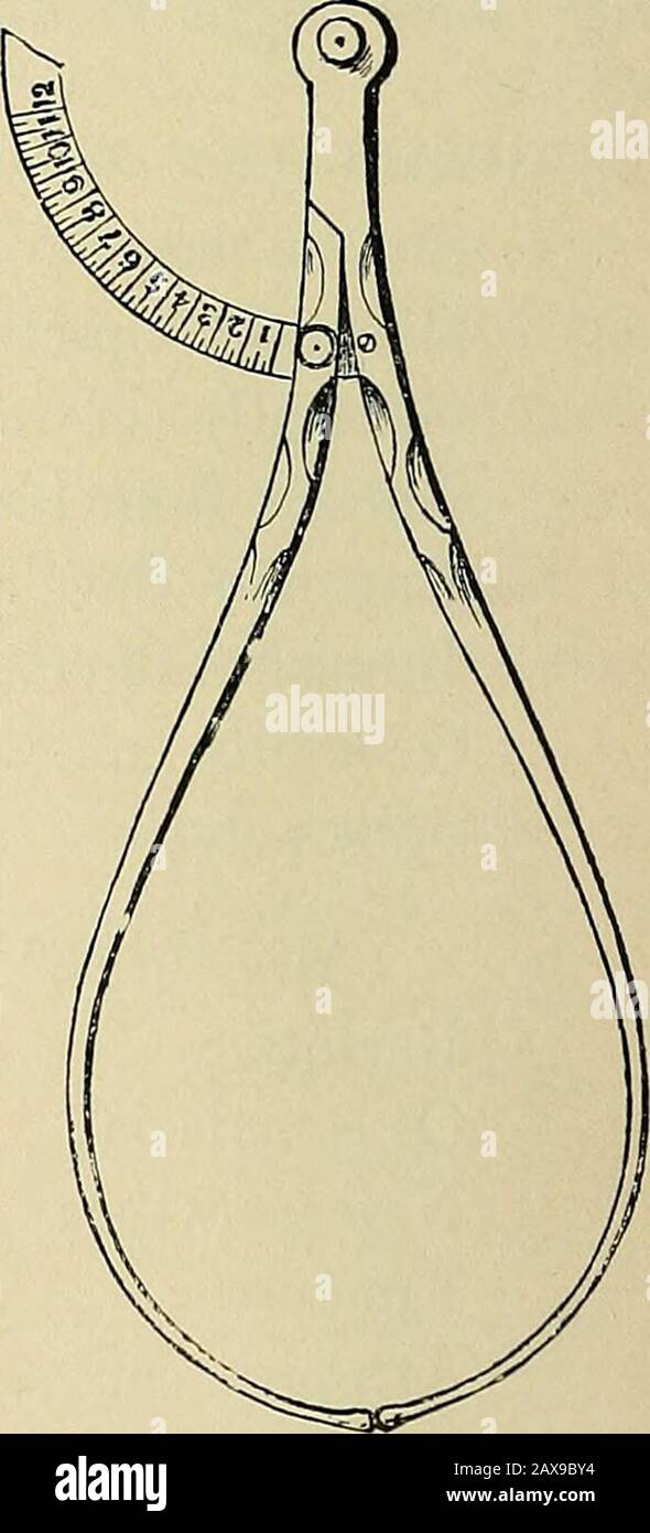 Le livre américain d'obstétrique pour les praticiens et les étudiants . Fig. 1.—combinaison Moderne de pelvimètres Baude-loques et Osianders. Fig. 2.—Osianderspelvimètre. Fig. 3.—Martinspelvimètre. Points saillants sur le corps des womans correspondant le plus près possible avec les mesures internes souhaitées ; les relations entre les deux derniers ravages ont été déterminées par de nombreuses observations sur les corps morts et vivants. Radiog-raphy a une utilité limitée dans la détection des anomalies de forme pelvienne, D YSTOCIA. 25 comme dans un bassin obliquement contracté. Pour prendre des mesures pelviennes, les doigts des examinateurs Banque D'Images