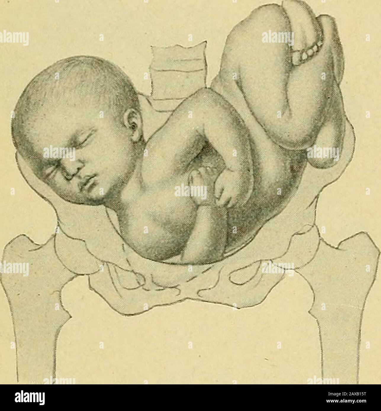 La pratique de l'obstétrique, conçue pour l'utilisation des étudiants et des praticiens de la médecine . Fig. 736.—épaule gauche dans Le Cer-vix. 540 TRAVAIL PATHOLOGIQUE. TROISIÈME POSITION D'ÉPAULEMENT. La Scapula droite postérieure, R. Scap. P.. Est la grande cause de la présentation de l'épaule. (Page 423.) la mort et la macérationdu fœtus et la grossesse multiple pour des raisons similaires sont des causes. (Page 423.) Dans le tractus partuent la déformation pelvienne, l'obliquité pelvienne excessive, et l'obliquité latérale excitante de l'utérus sont des causes en interférant soit avec la propriété de l'enfant, soit avec l'engagement prêt de la tête Banque D'Images
