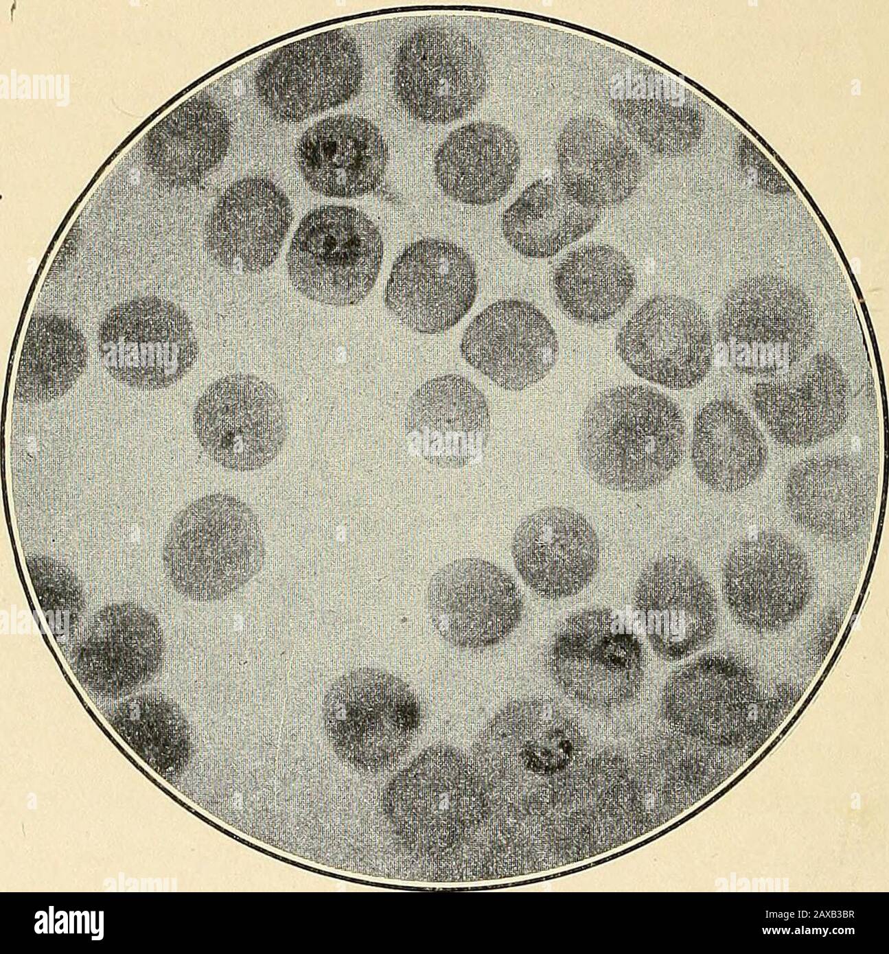 Les fièvres malariaux, la fièvre hémoglobinurique et les protozoaires sanguins de l'homme . odium, ou Plasmodium falciparum, apparaissent d'abord dans le corpuscle rouge infecté comme un anneau ou un disque d'hyaline rond ou ovale, Mais même dans les 38 ÉTIOLOGIE DES FIÈVRES MALARIAUX, les premières étapes du développement du schizont importantes différences sont à se faire entre cette espèce et les espèces quotidiennes. Les jeunes plasmodiaânes tertiens sont beaucoup plus grands que ceux des espèces quotidiennes, occupant le quart de la mousse à un tiers de la cellule rouge infectée, qui, alors que les cellules plus petites de la couleur normale l'entourent, et le verdâtre dedans Banque D'Images
